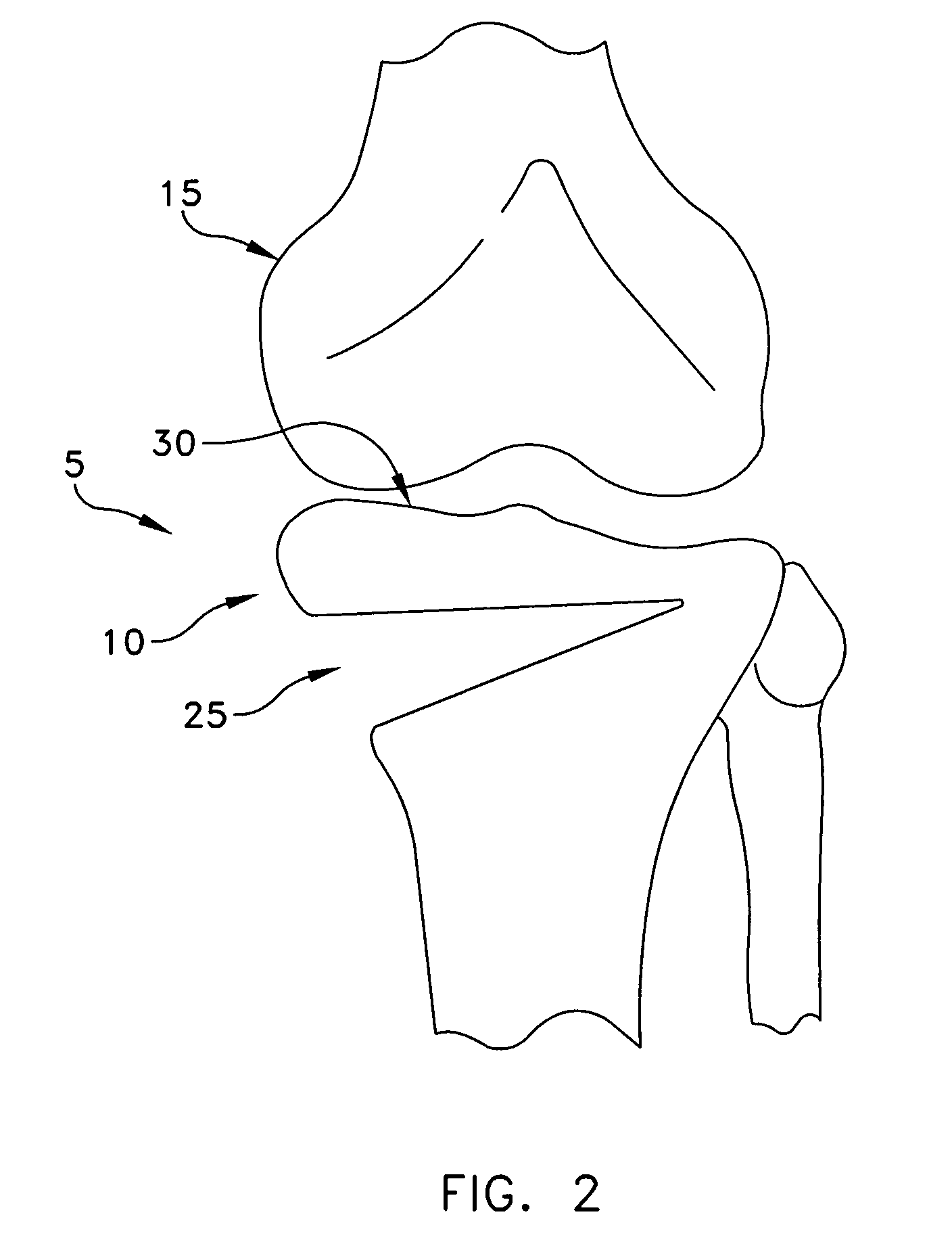 Multi-part implant for open wedge knee osteotomies