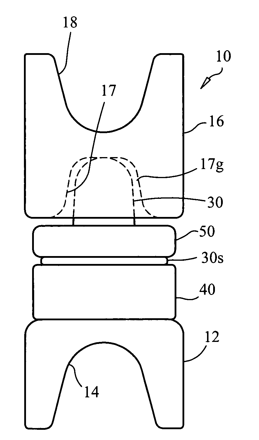 Interspinous dynamic stabilization implant and method of implanting