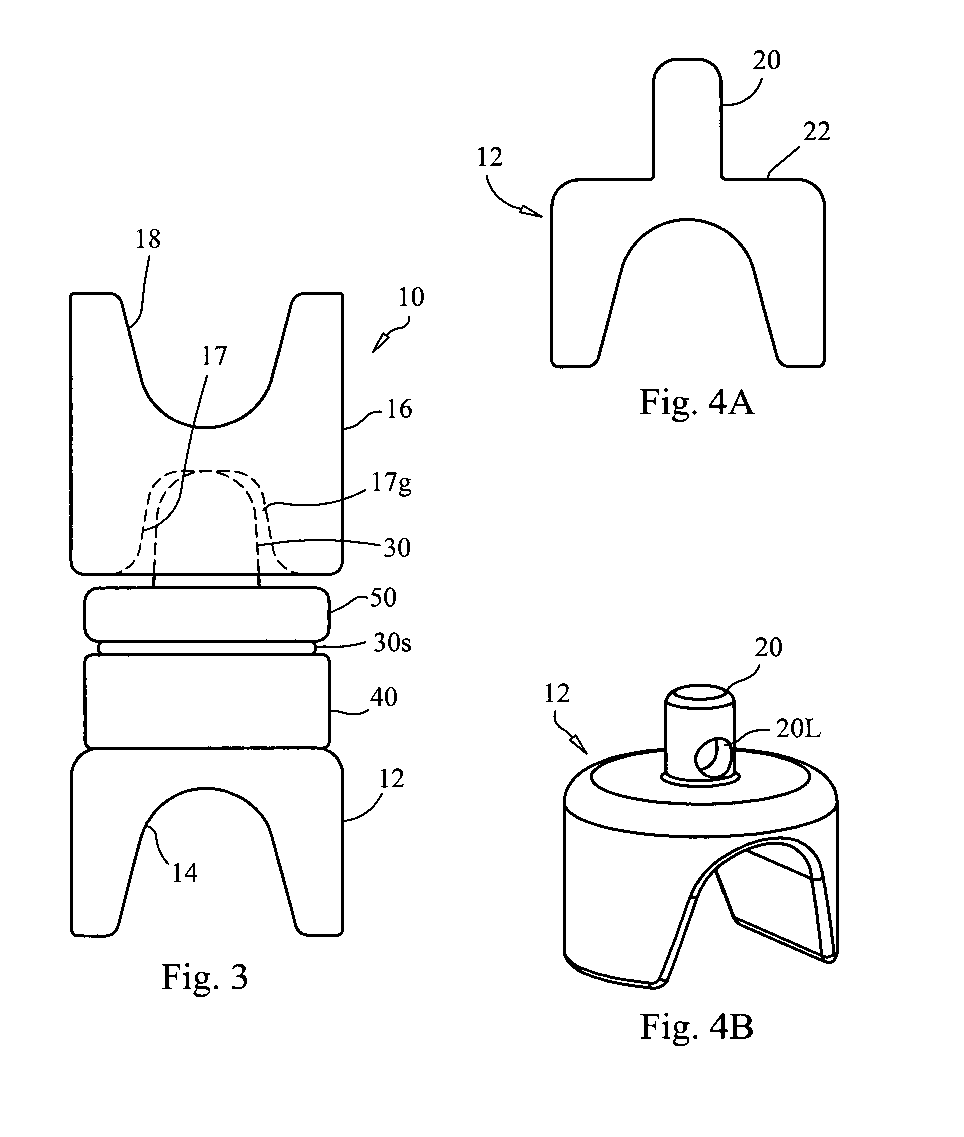Interspinous dynamic stabilization implant and method of implanting