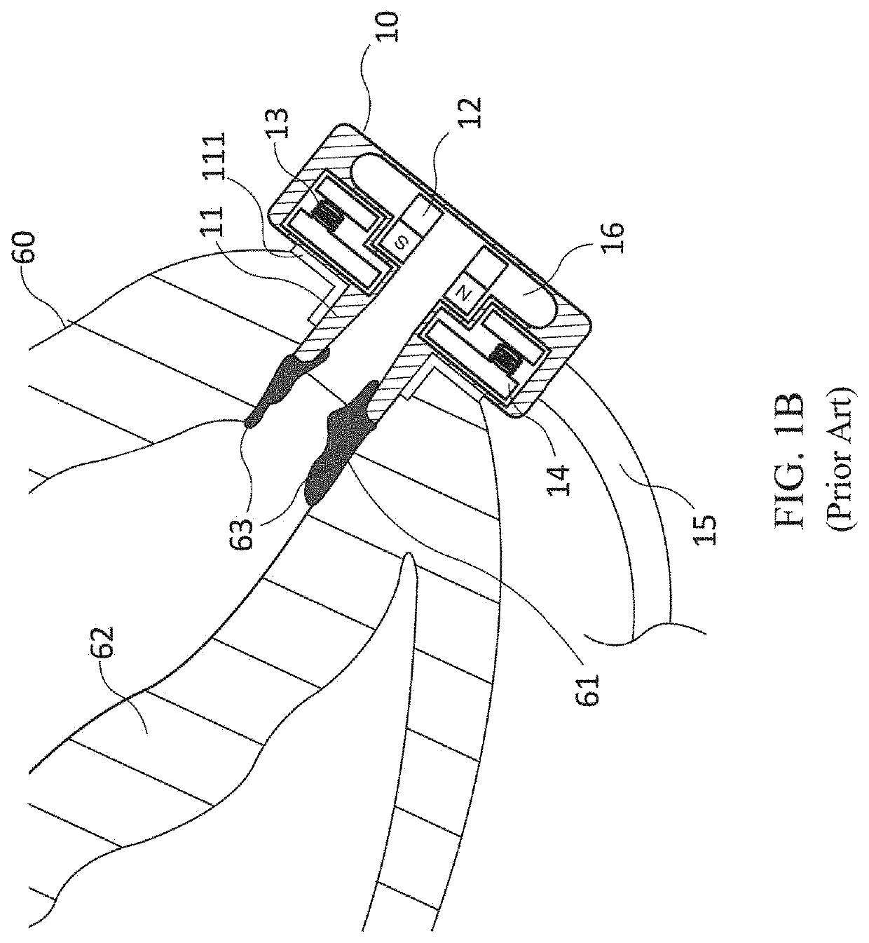 Sutureless inflow cannula assembly for connecting ventricular assist devices to human circulation