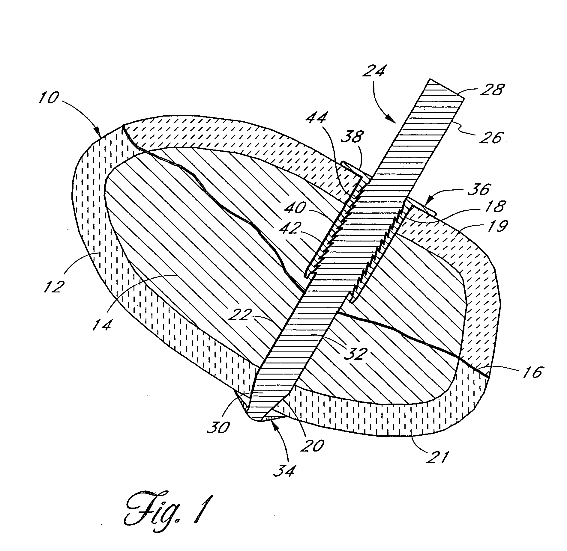 Bone fixation system with radially extendable anchor