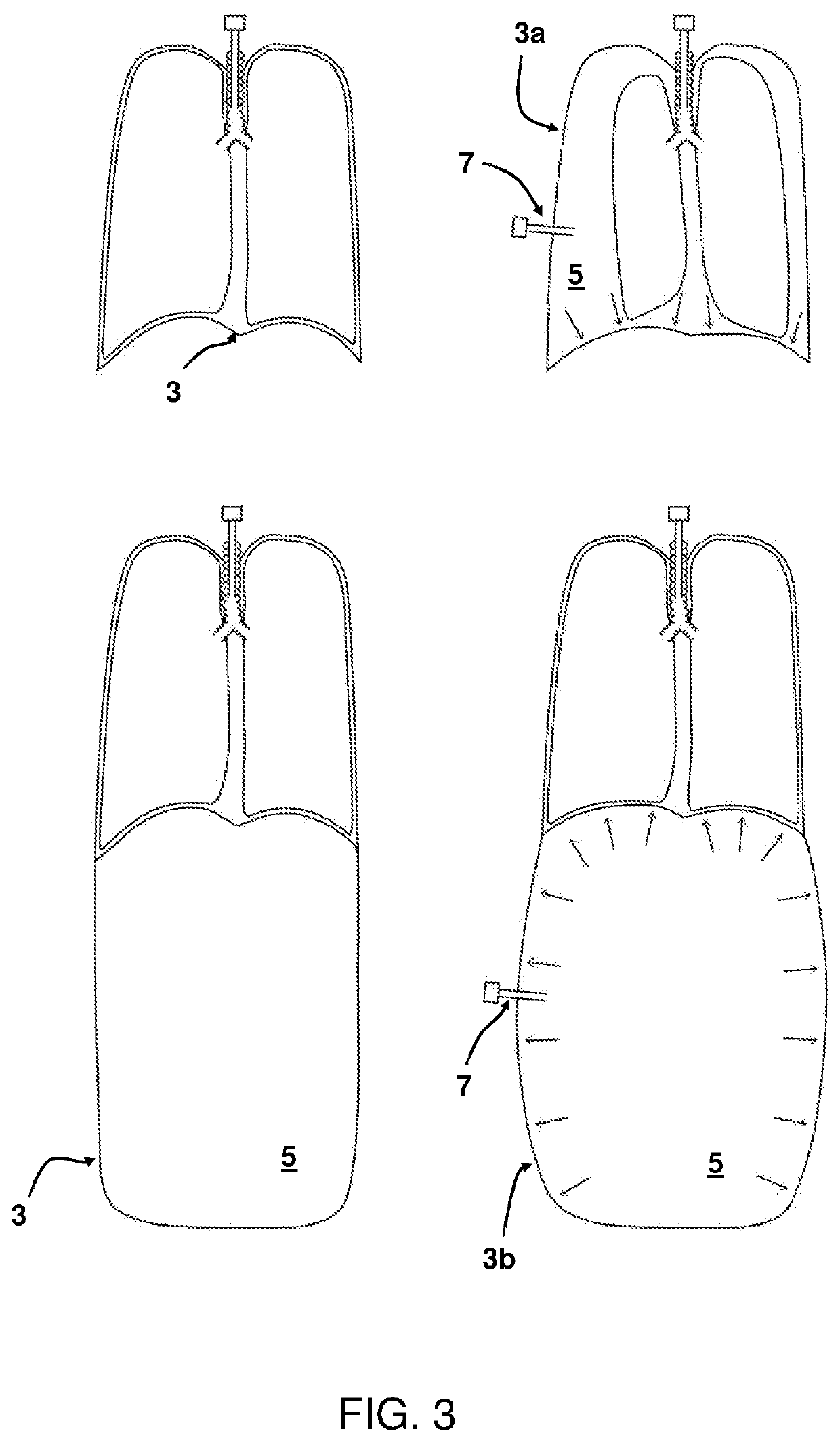 An insufflator for exposing structures within an internal body cavity