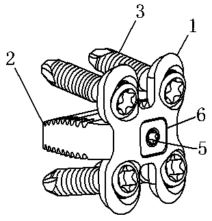Embedded anterior cervical compression fusion fixing device