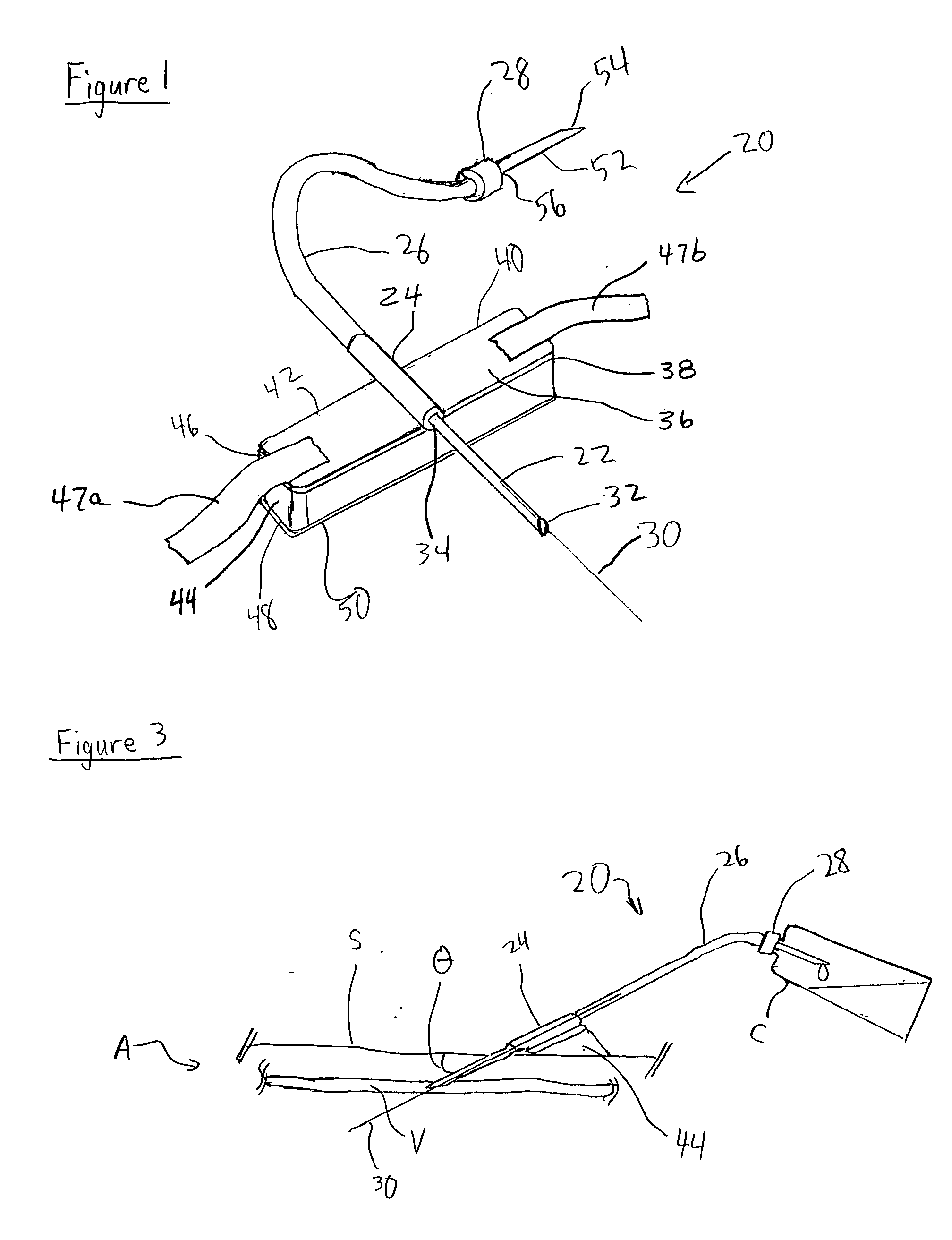 Intravenous needle assembly and method of use