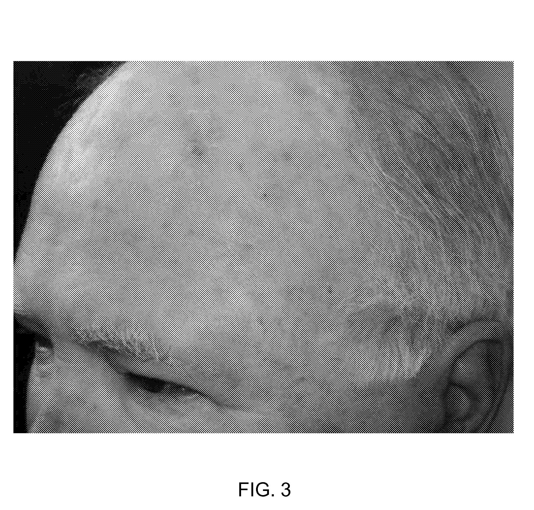 Novel treatments for actinic keratoses