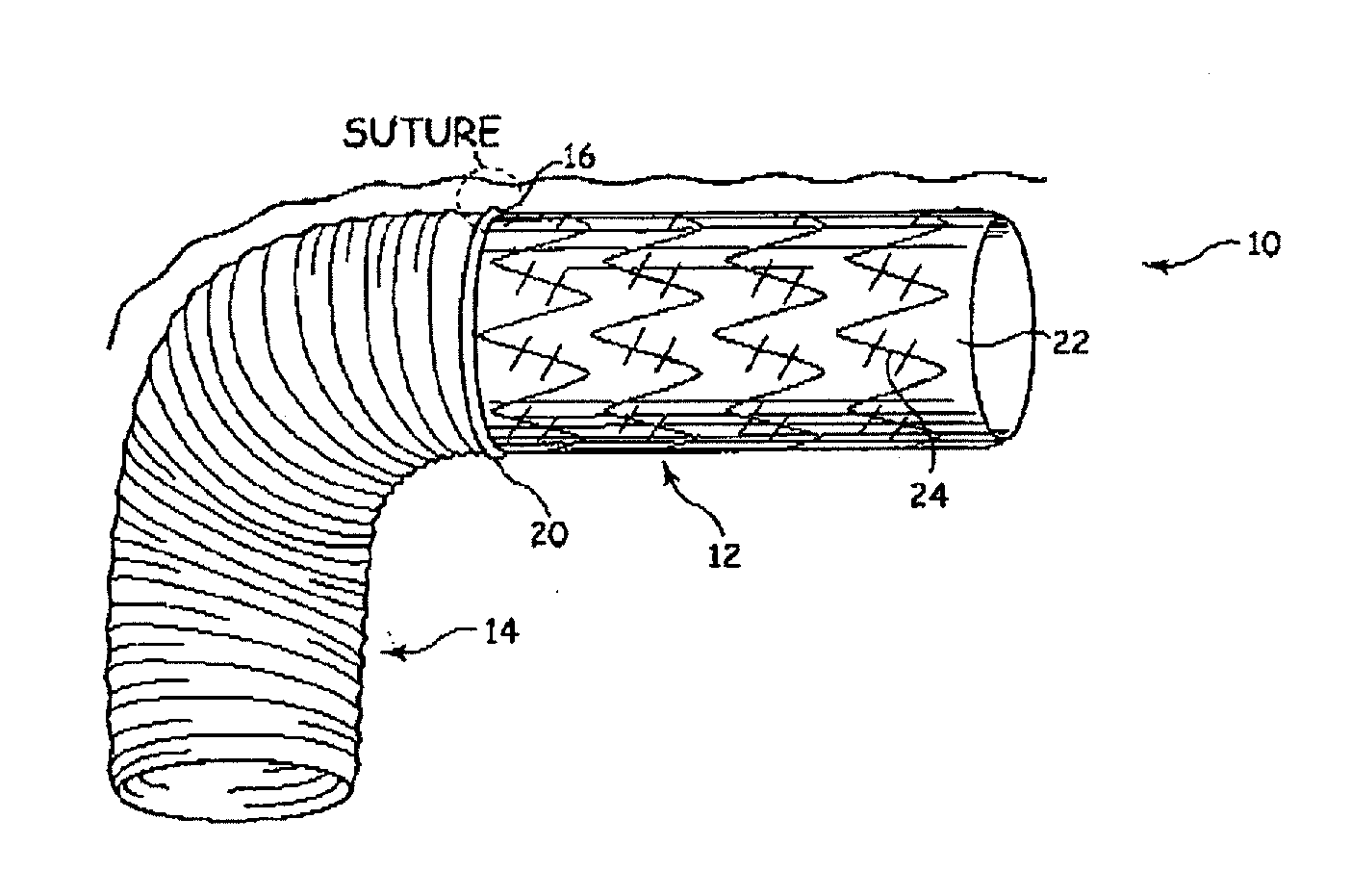 Aortic graft device