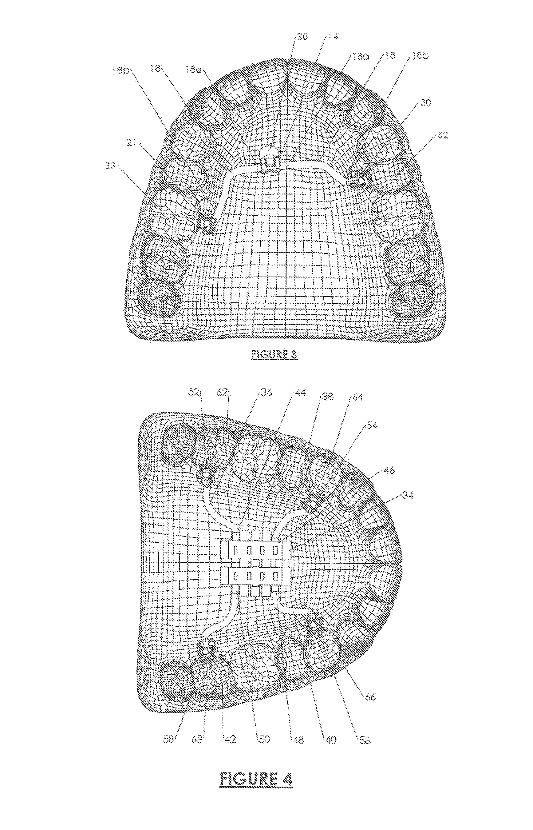 Orthodontic anchoring method and apparatus