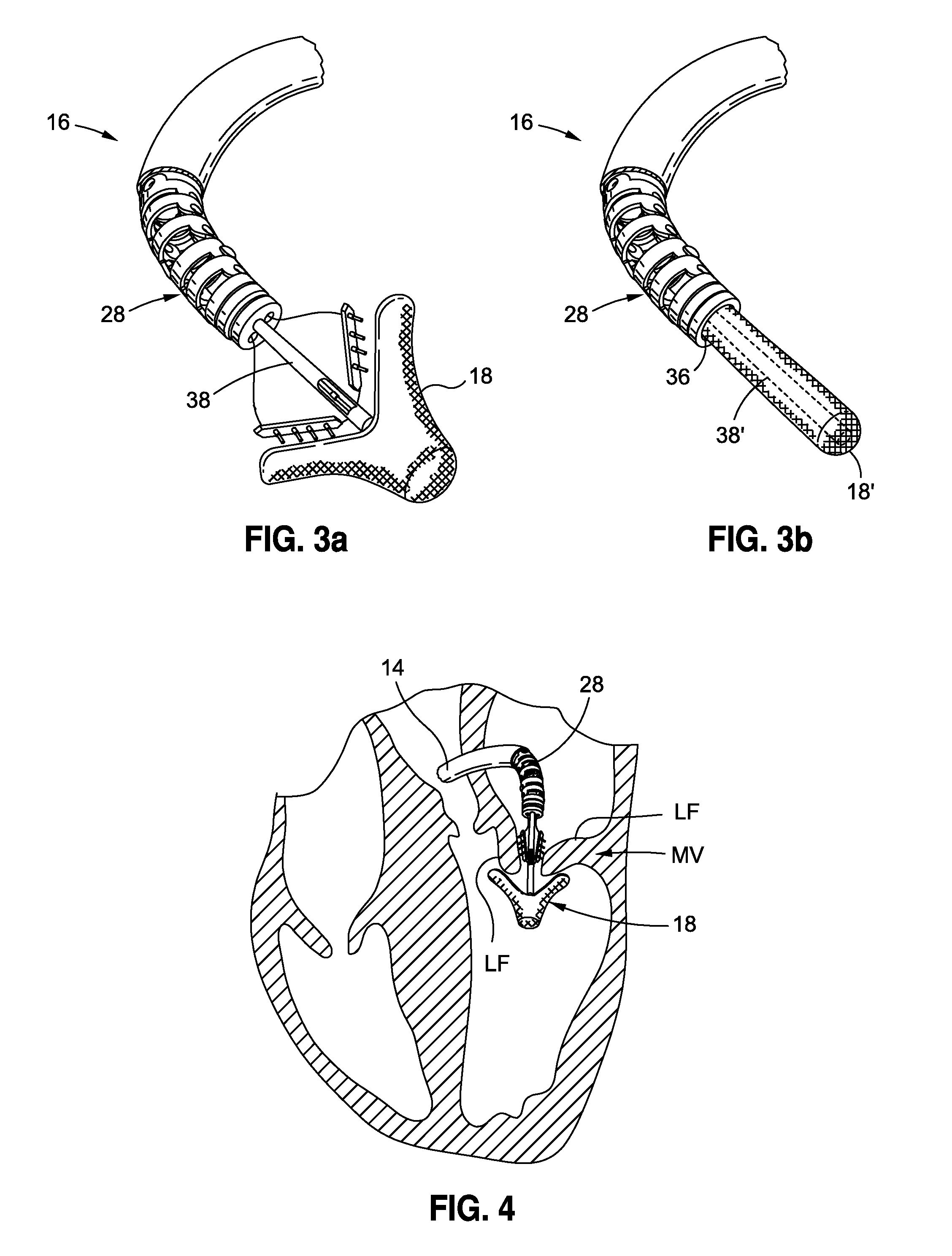 Steerable assembly for surgical catheter