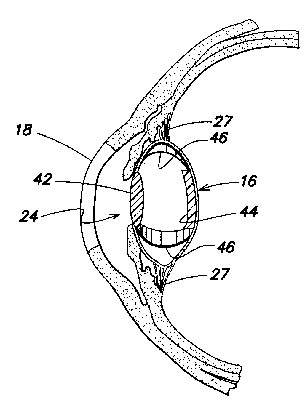 Multi-Element Accommodative Intraocular Lens