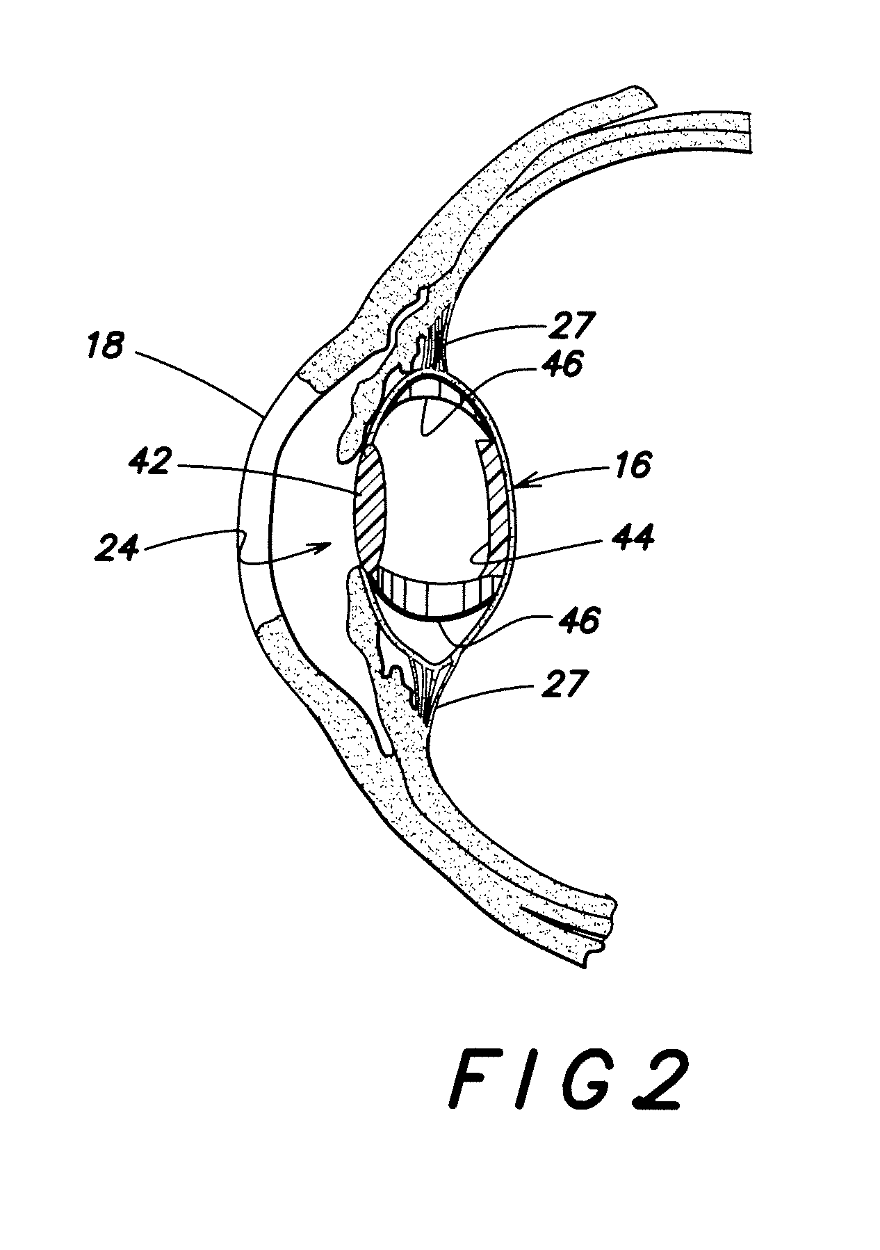 Multi-Element Accommodative Intraocular Lens