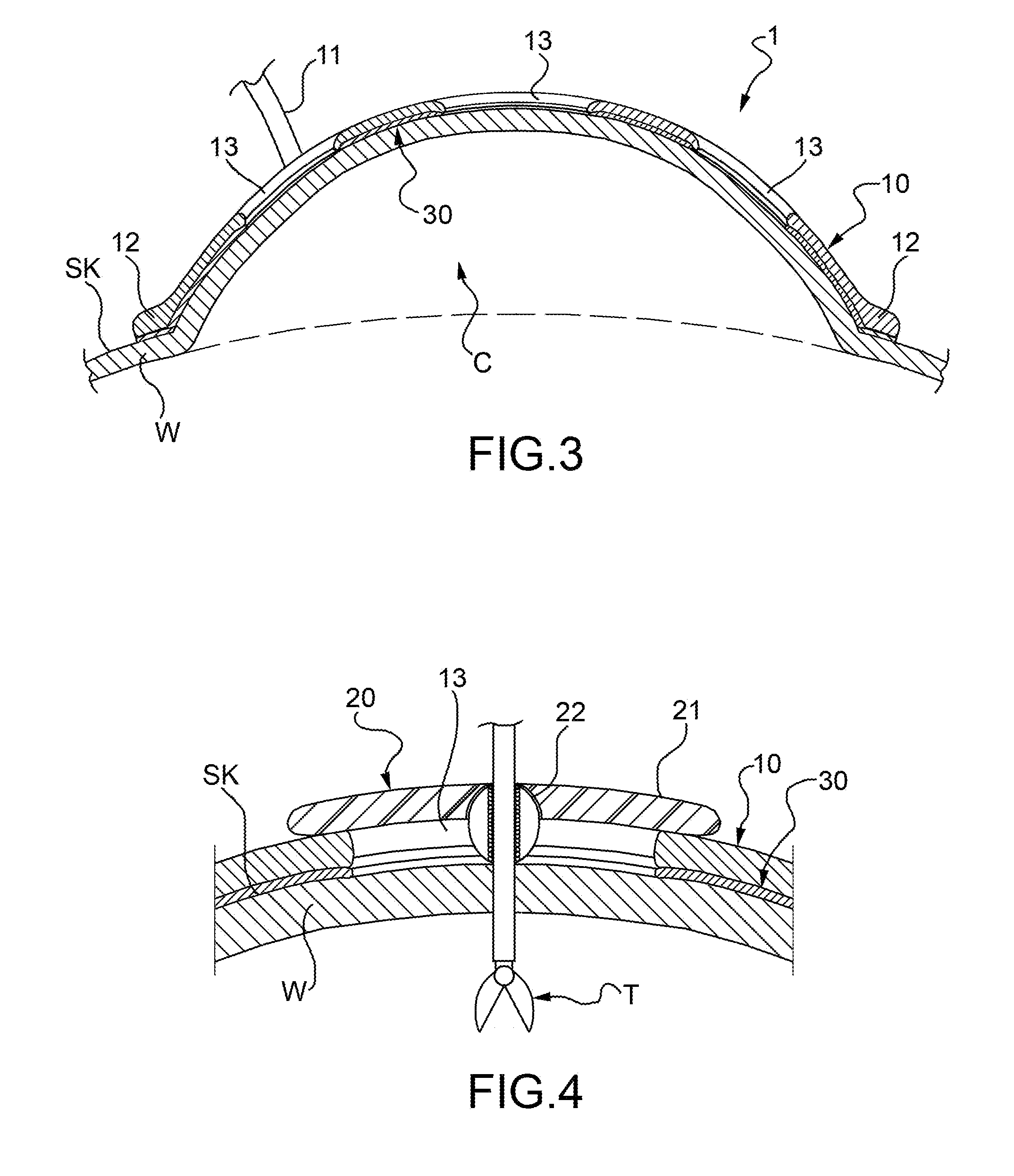 Surgical lift device to assist in surgical access through skin, tissue and organs