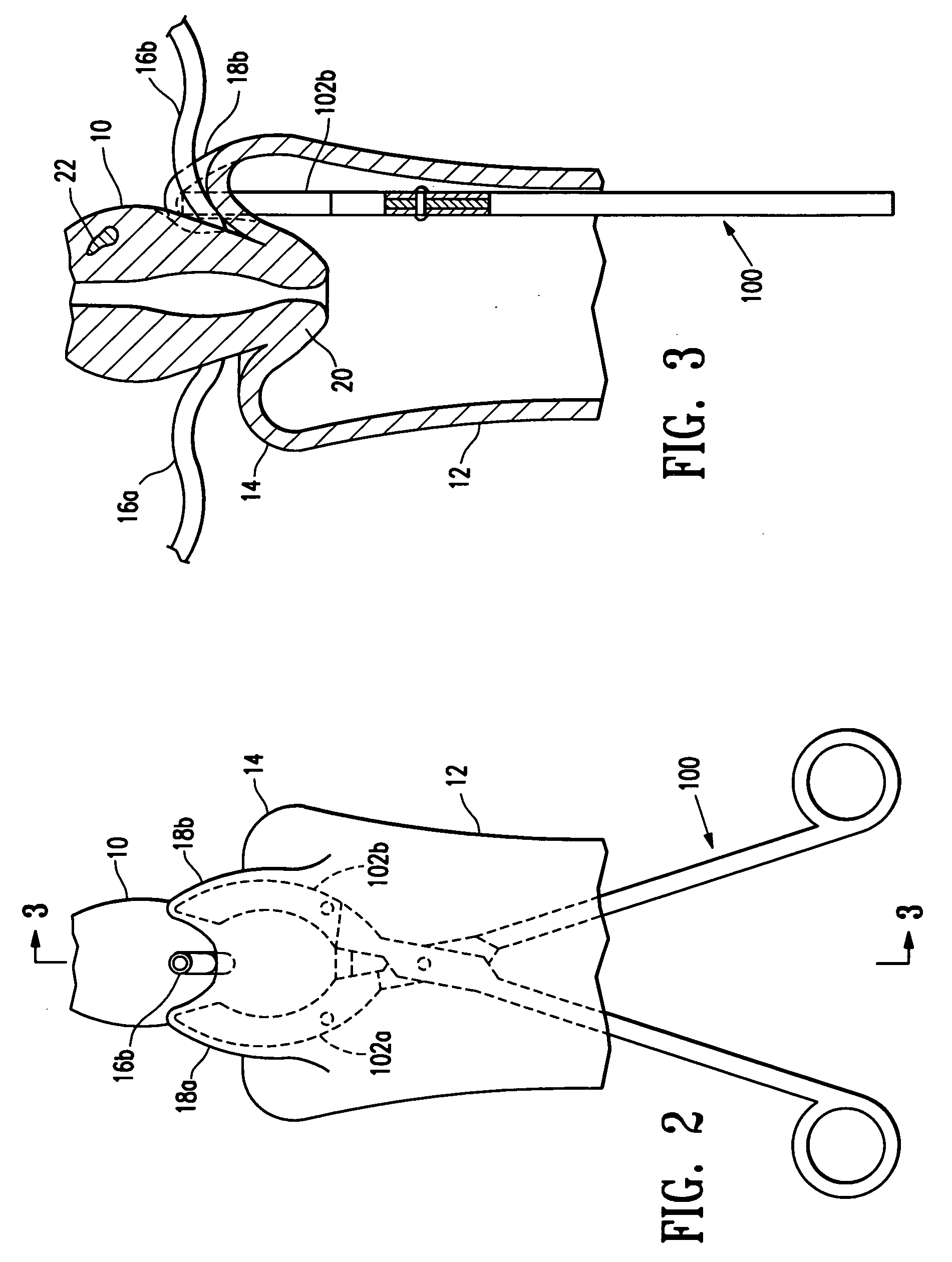 Methods for minimally invasive, non-permanent occlusion of a uterine artery