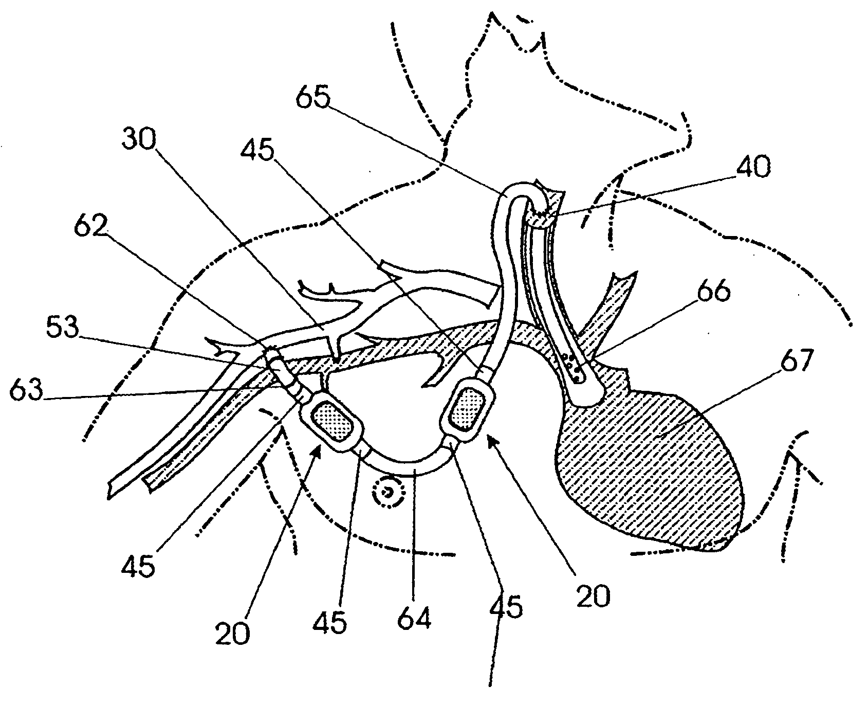 Squitieri hemodialysis and vascular access systems