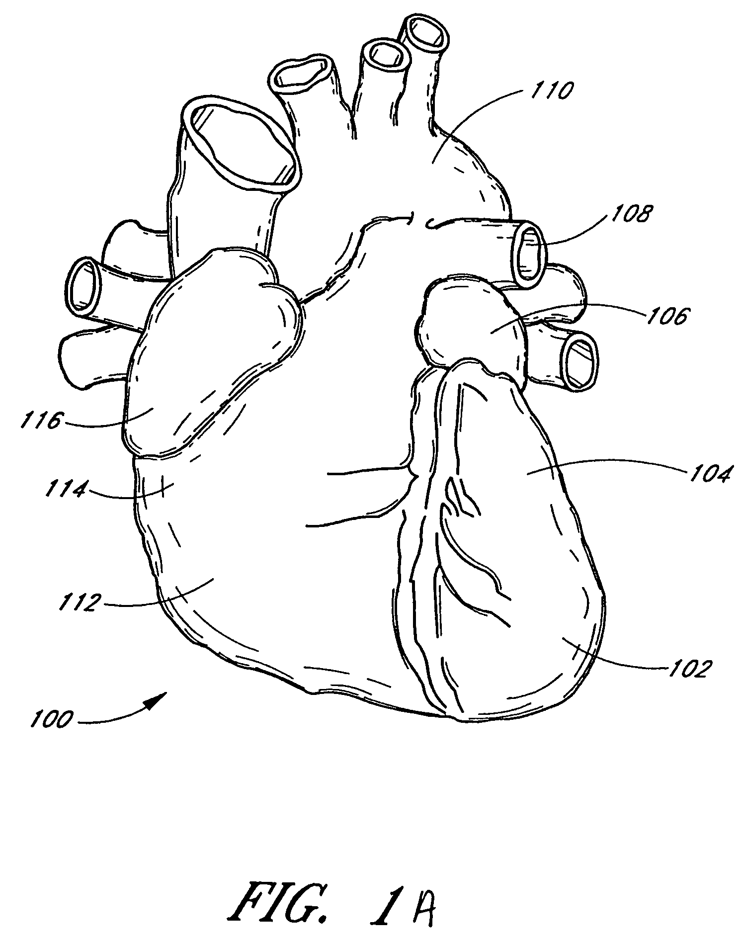 Intracardiac cage and method of delivering same