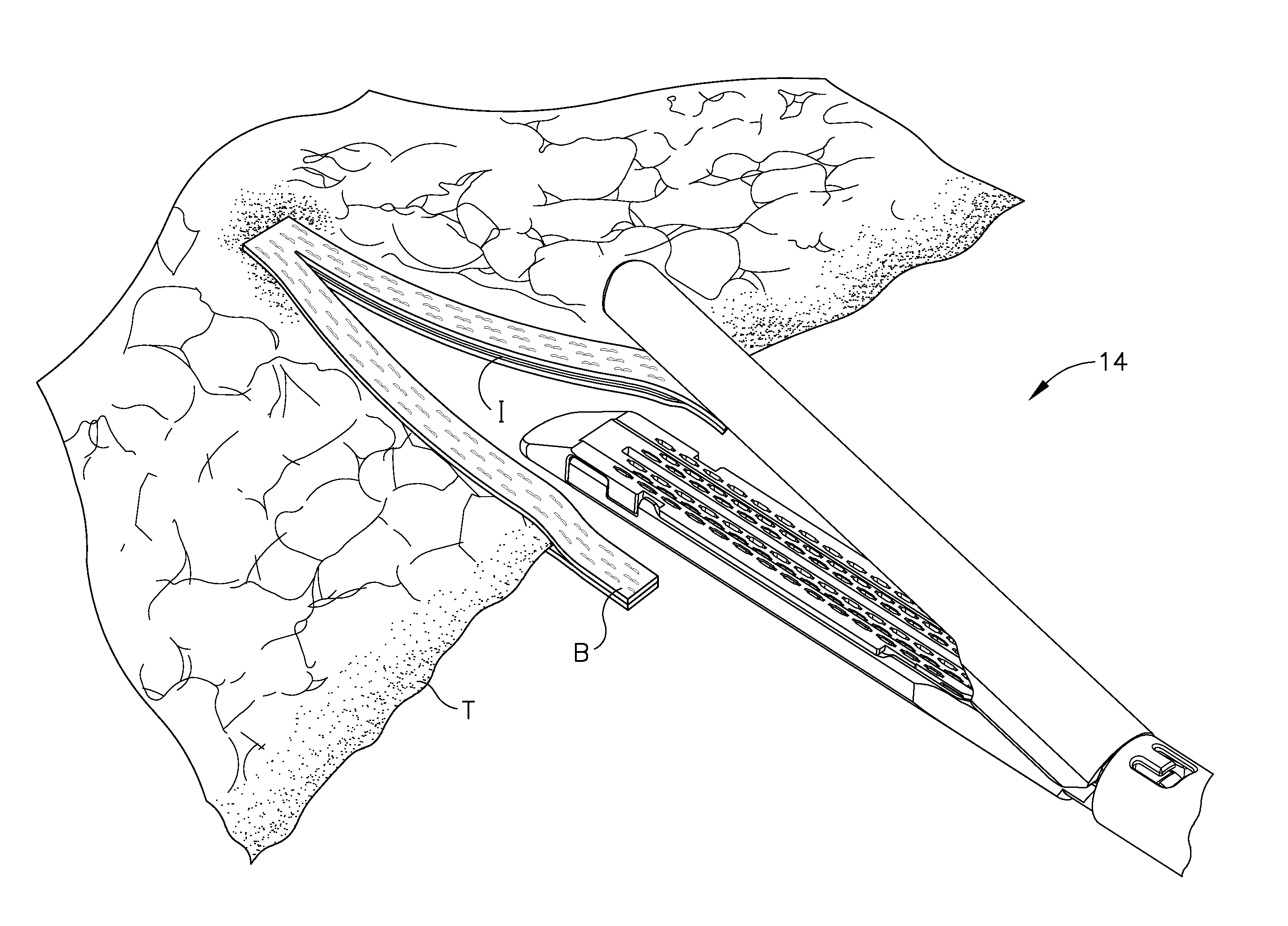 Buttress material for a surgical stapling instrument