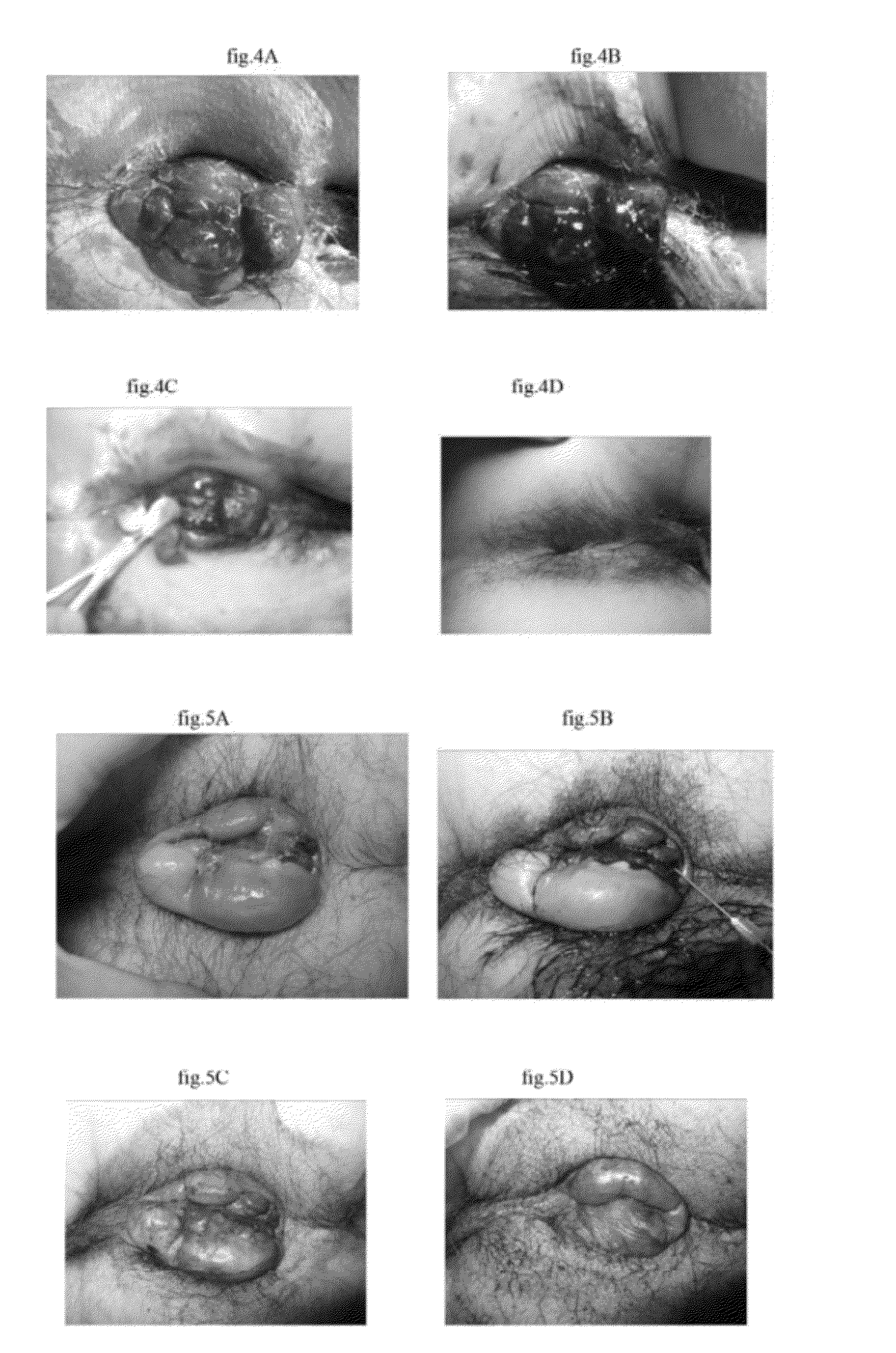 Pharmaceutical compositions for dehydrating, atrophying and eliminating pathological tissues