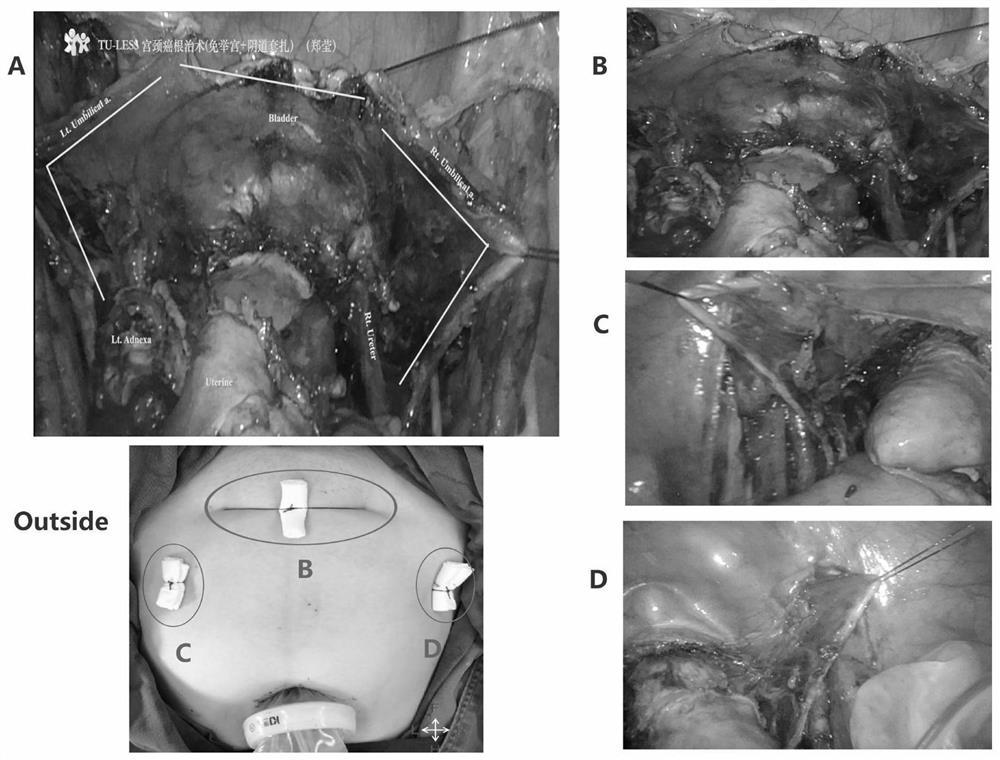 4C suspension method for assisting transumbilical single-port laparoscopic gynecologic malignant tumor surgery