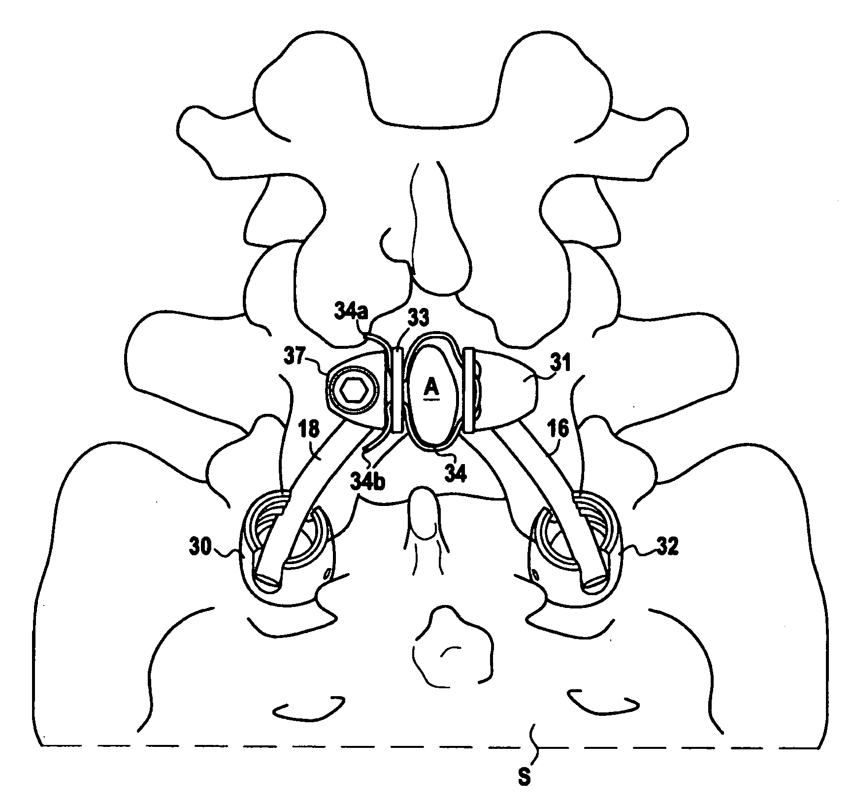 System for Stabilizing at Least a Portion of the Spine