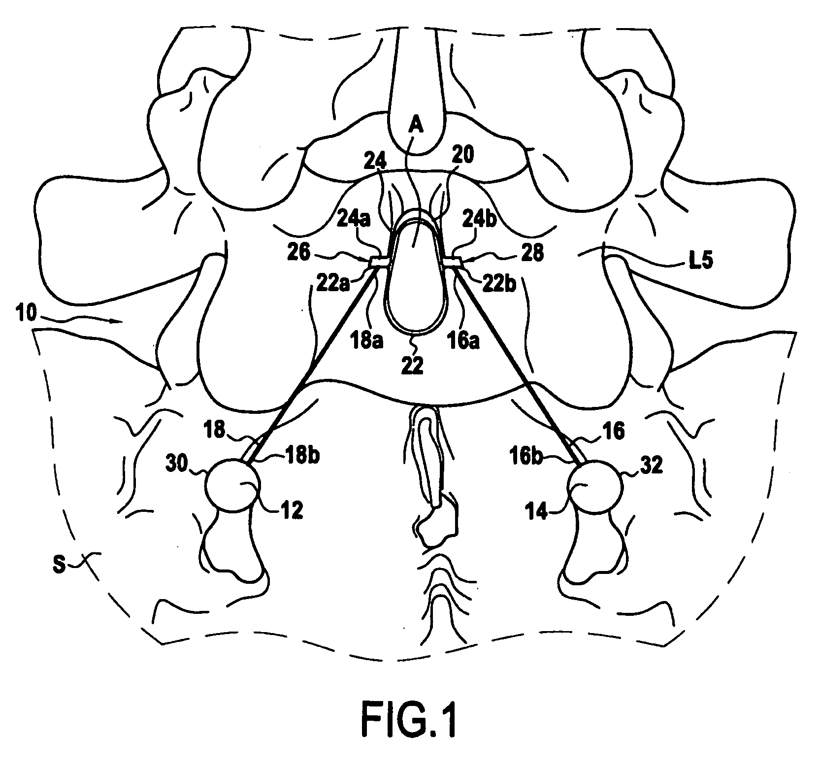 System for Stabilizing at Least a Portion of the Spine