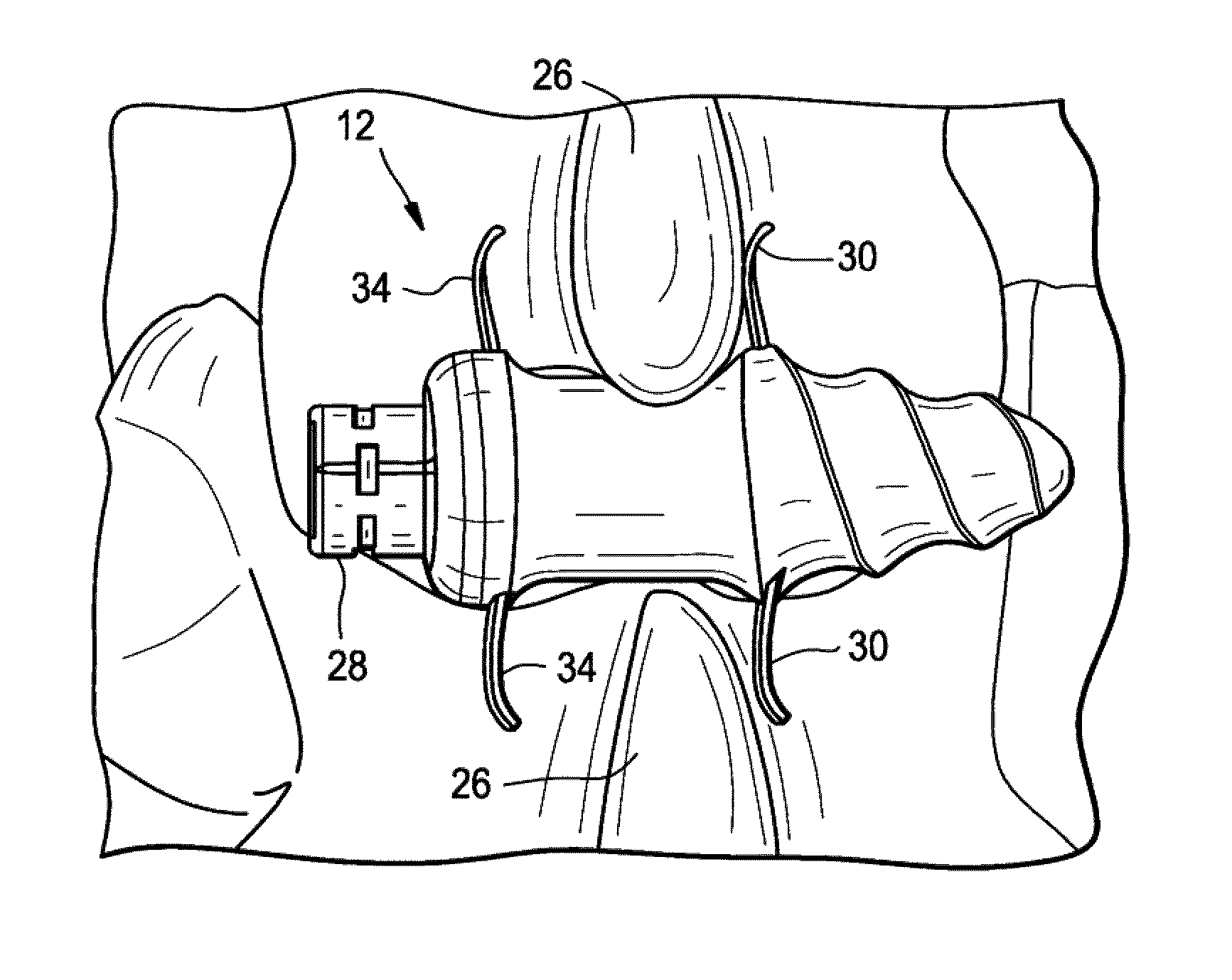 Conical interspinous apparatus and a method of performing interspinous distraction