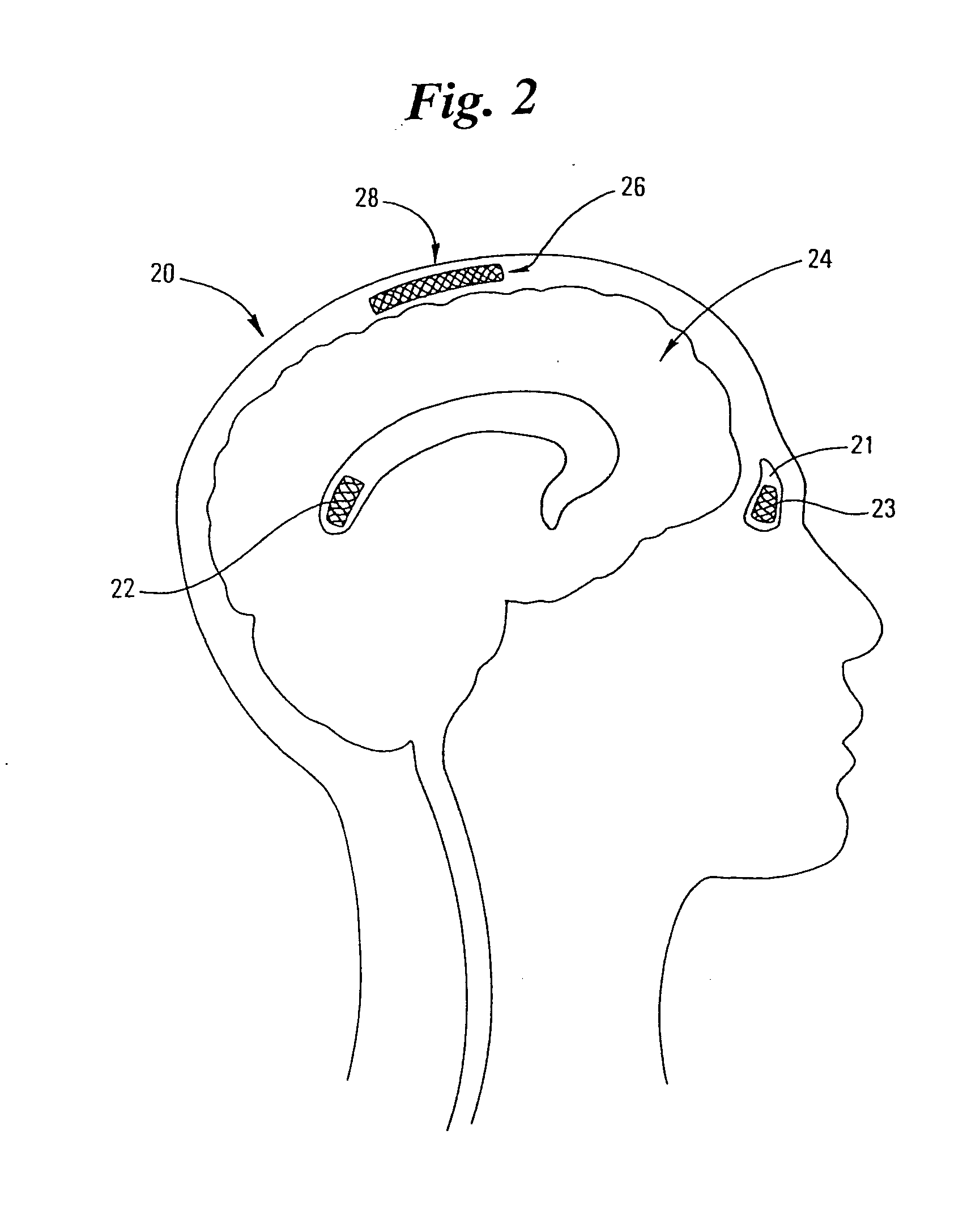 Methods and devices for the treatment of neurological and physiological disorders