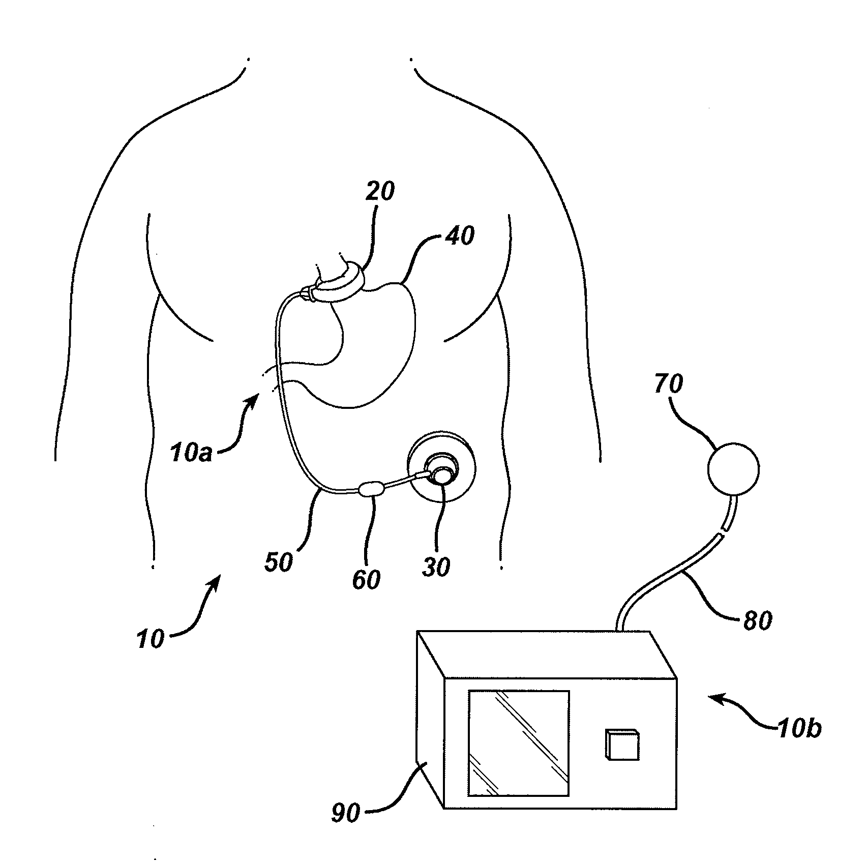 Adjustable height gastric restriction devices and methods