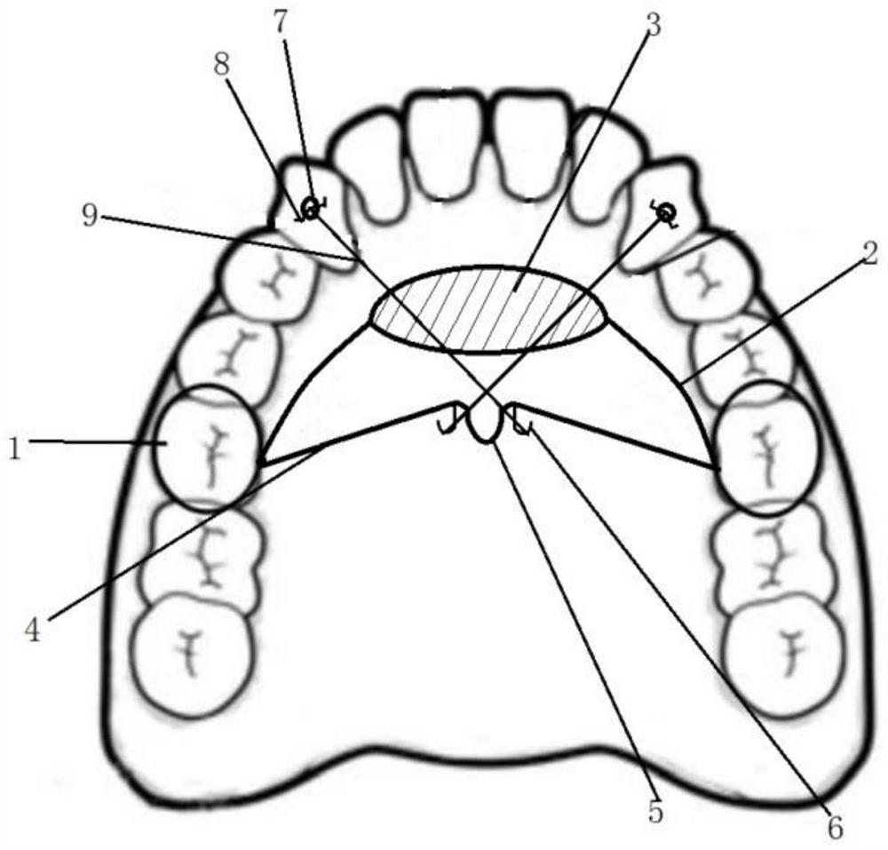 Improved Nance arch for traction of canine teeth