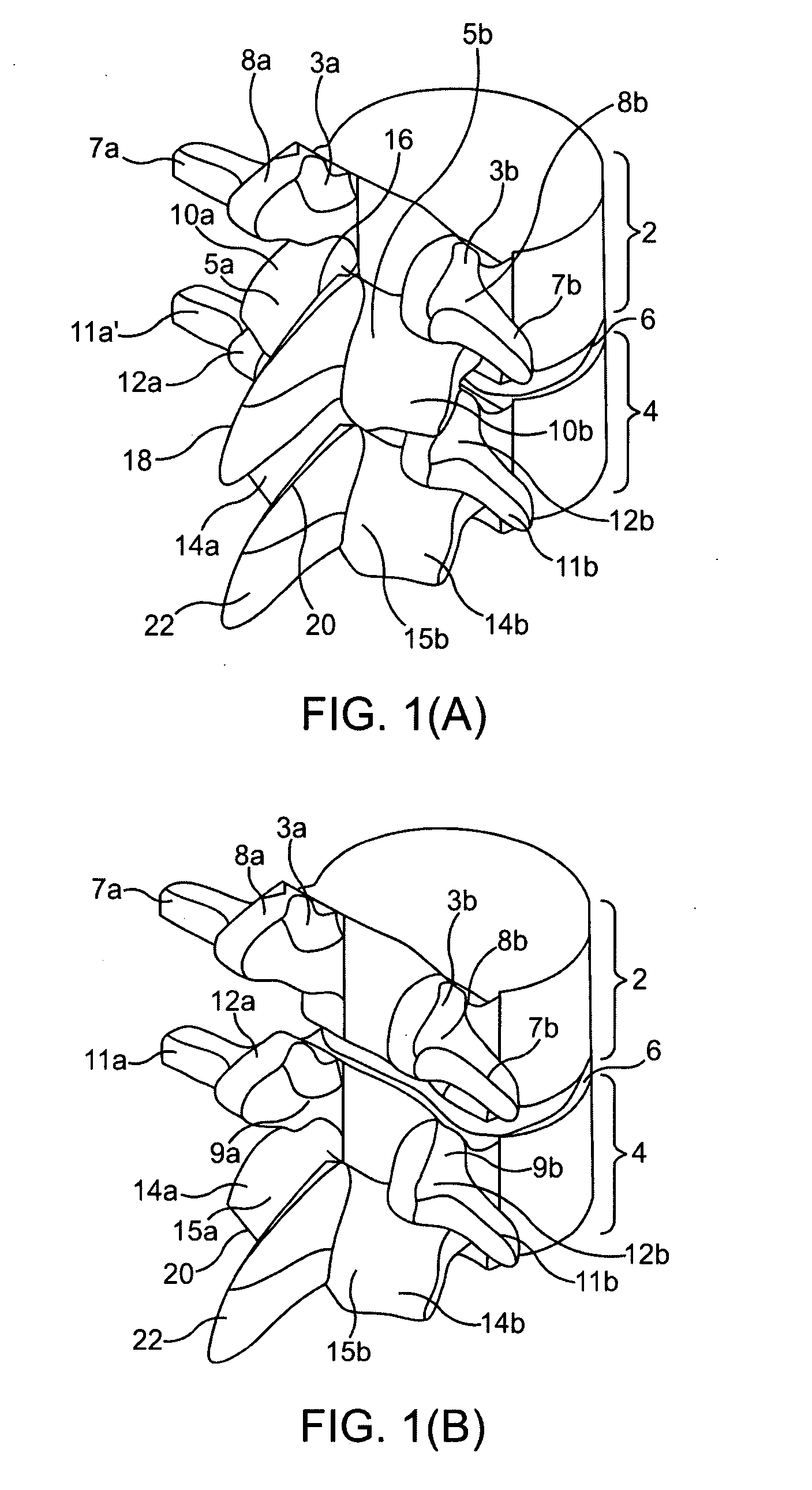 System and methods for posterior dynamic stabilization of the spine