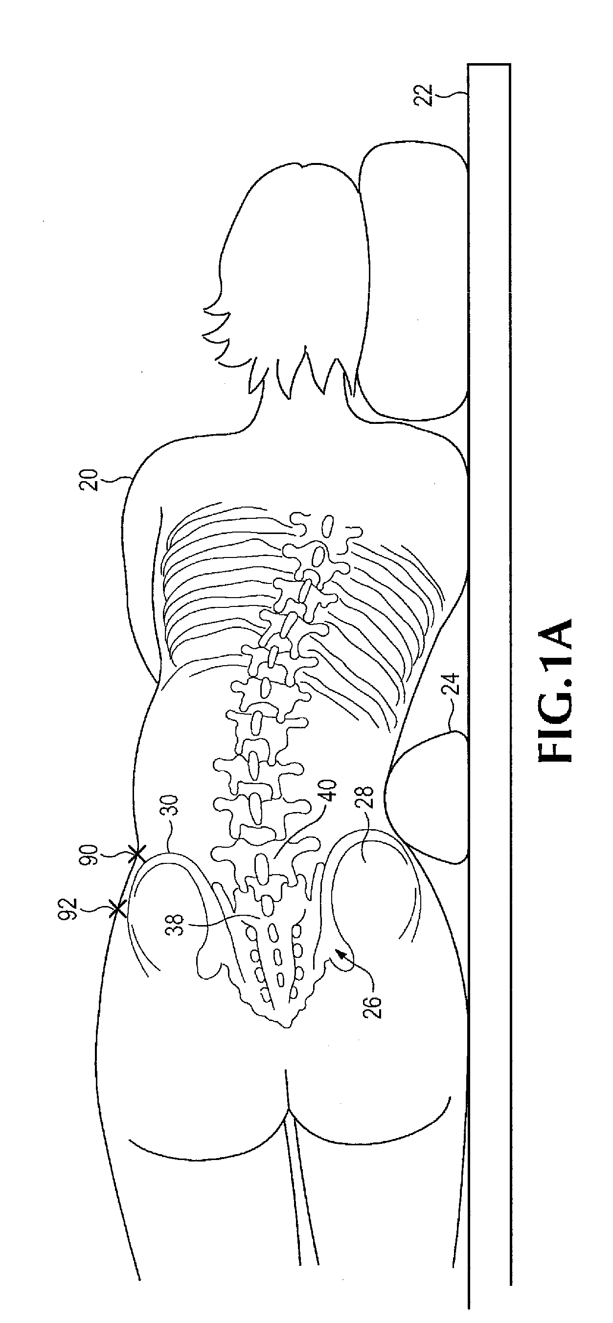 Retractor for use during retroperitoneal lateral insertion of spinal implants
