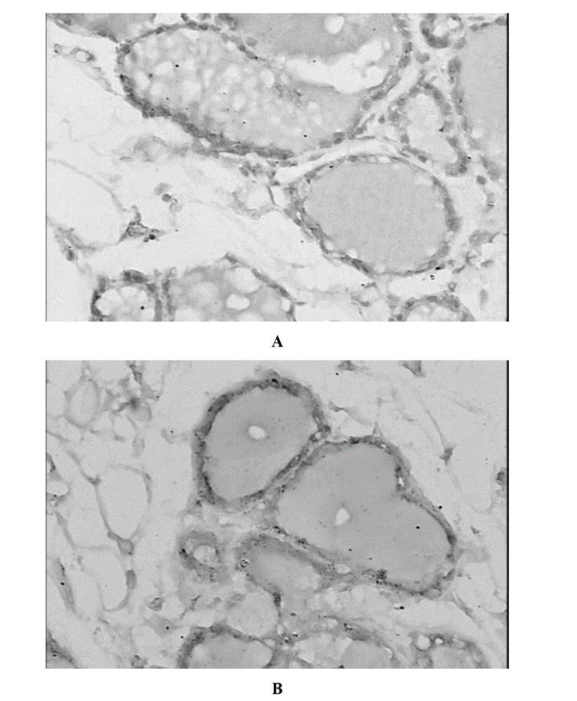 Breast nodule treatment medicine composition and preparation process and application thereof