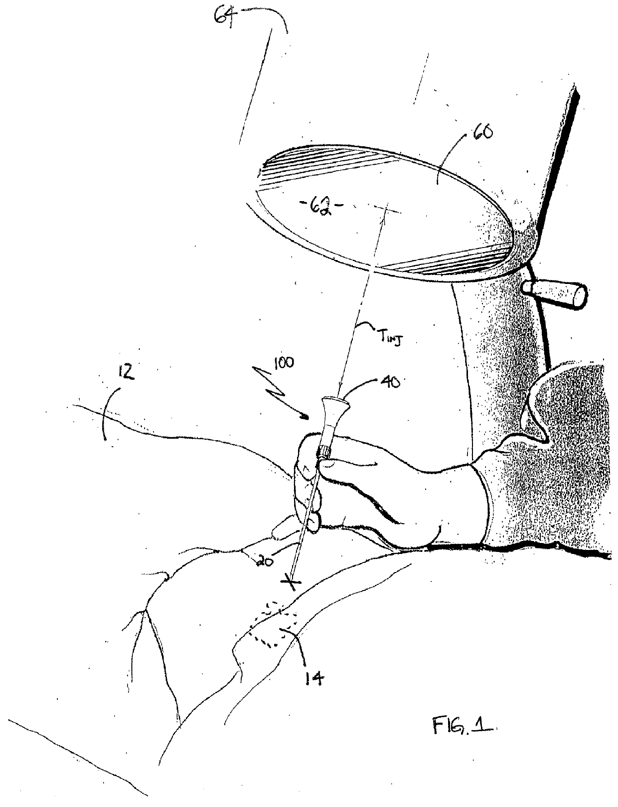 Percutaneous needle alignment system