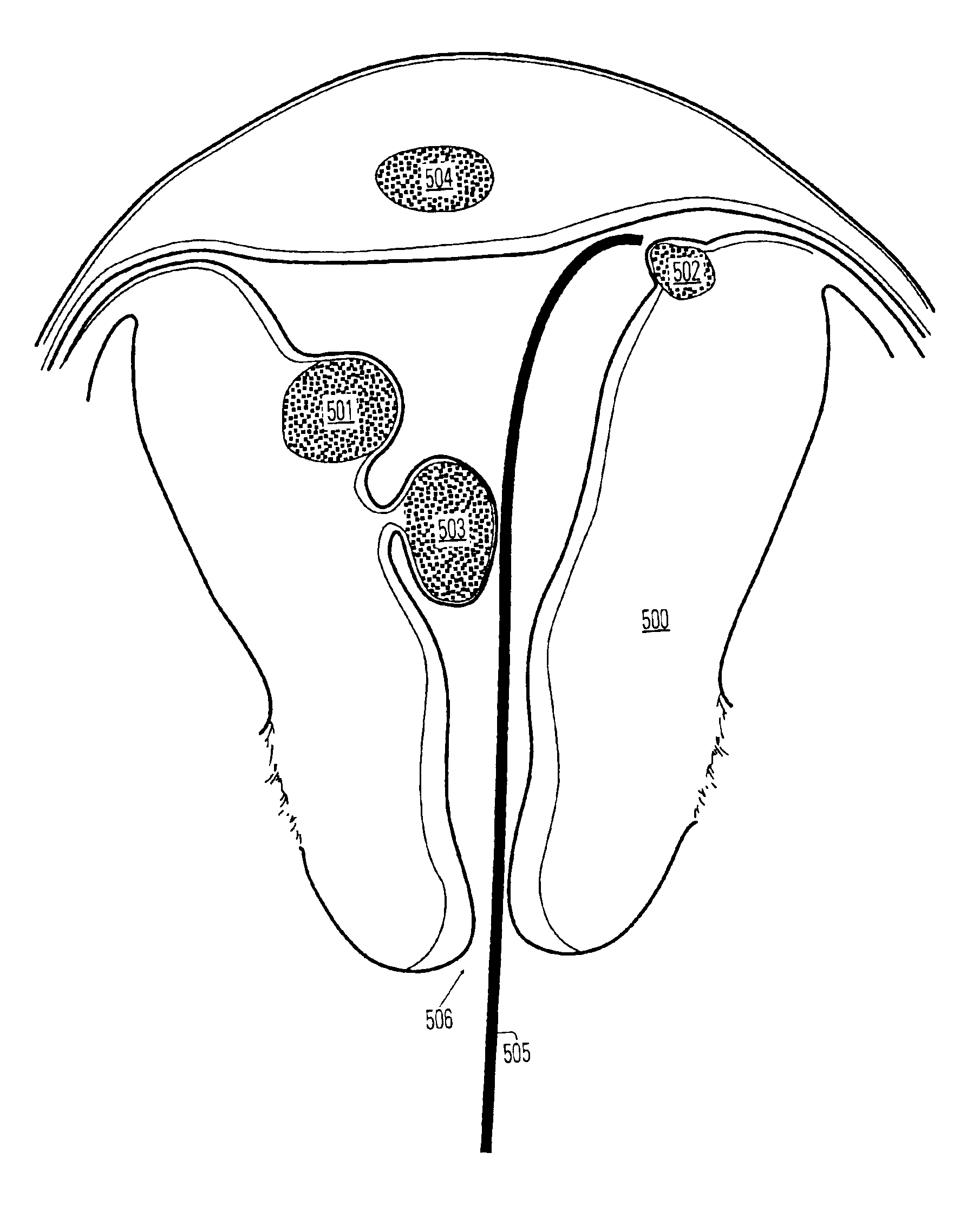 Method and system for photoselective vaporization for gynecological treatments