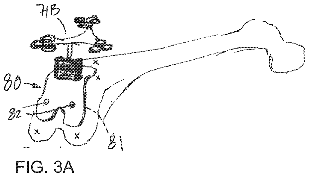 Method and system for validating bone alterations in computer-assisted surgery