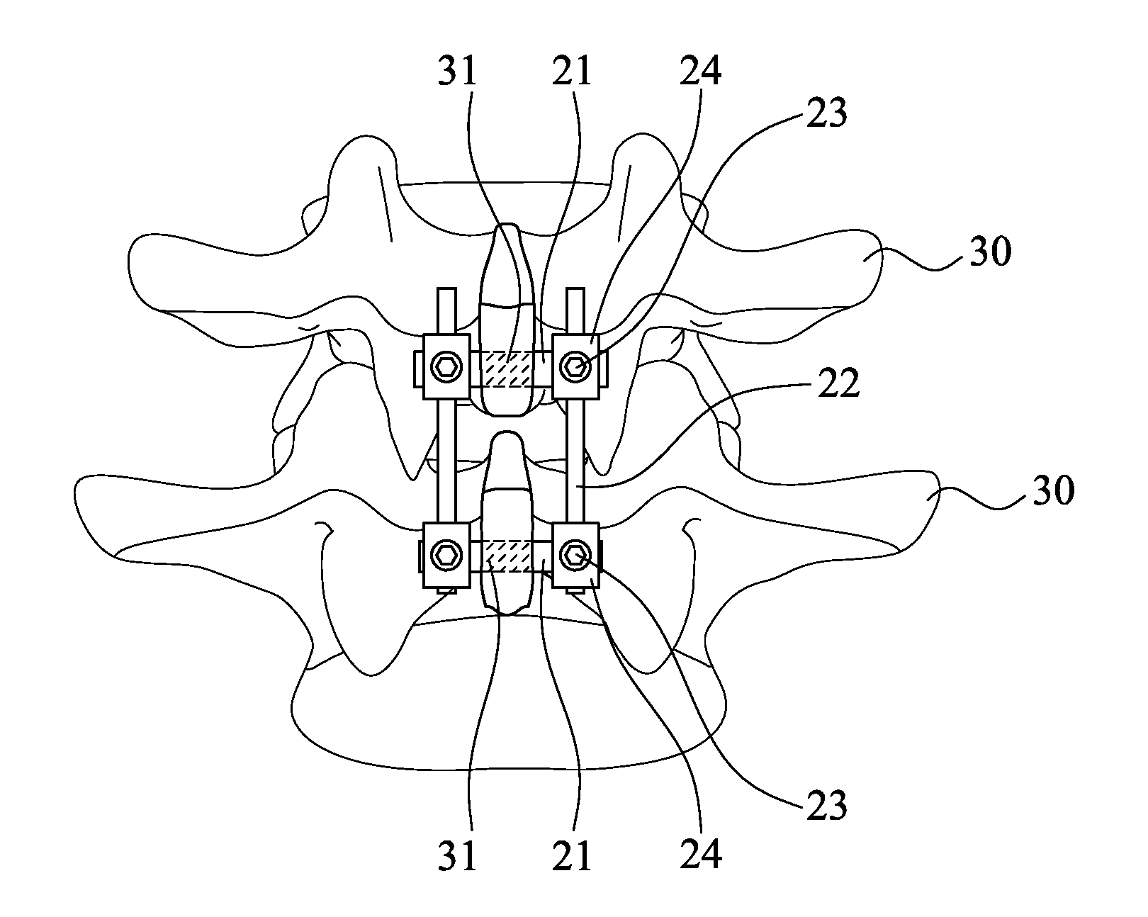 Device for connecting transverse beam at triangular position of vertebral lamina