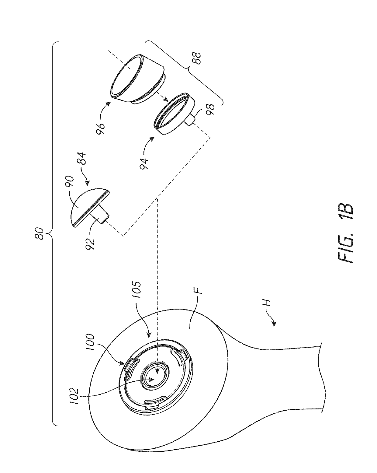 Stemless prosthesis anchor components, methods, and kits