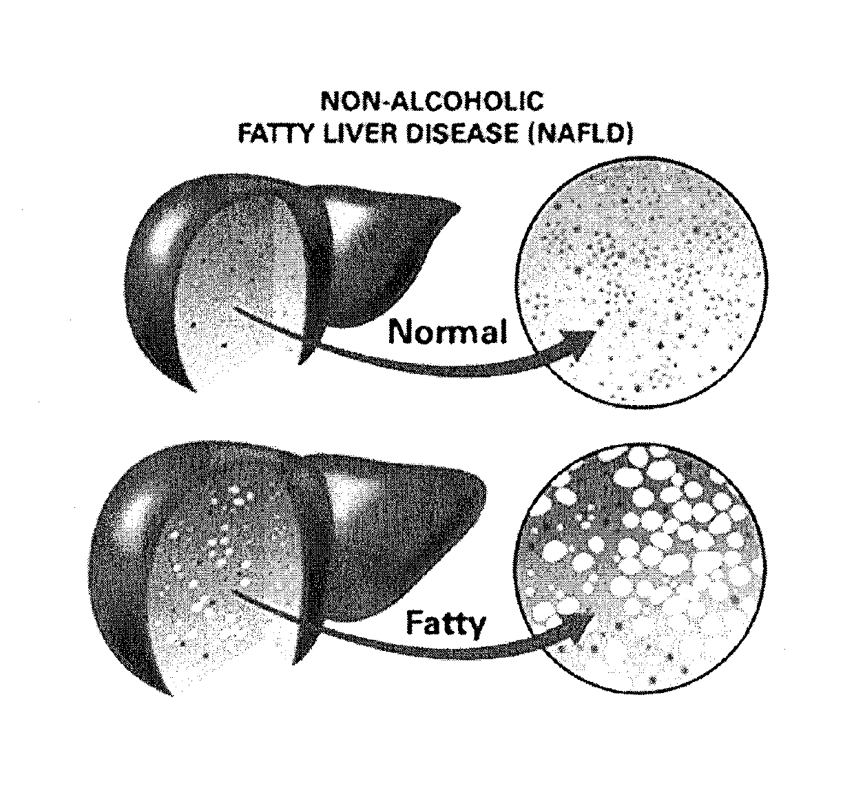 Method and system for reducing the likelihood of developing liver cancer in an individual diagnosed with non-alcoholic fatty liver disease