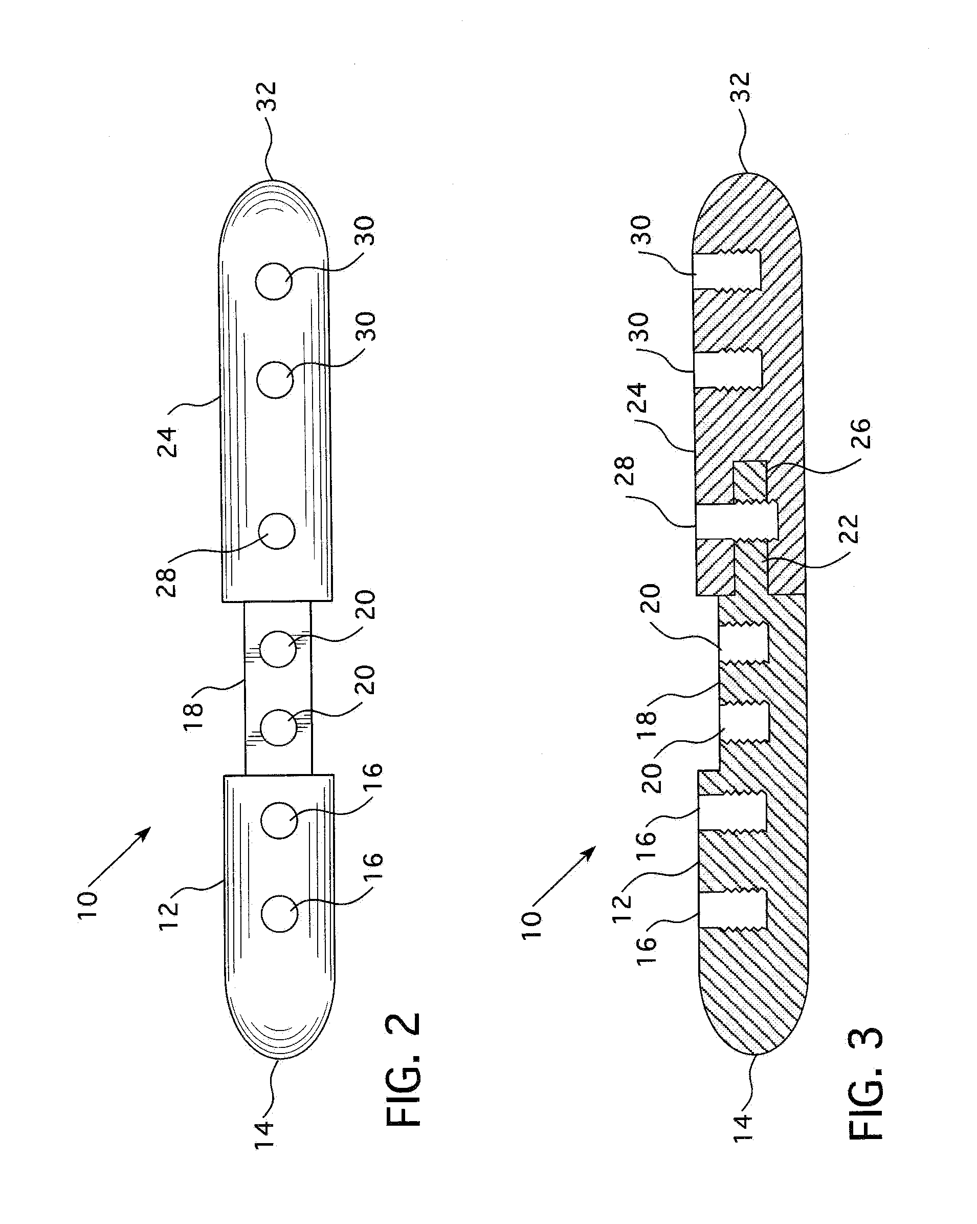 Intramedullary Nail