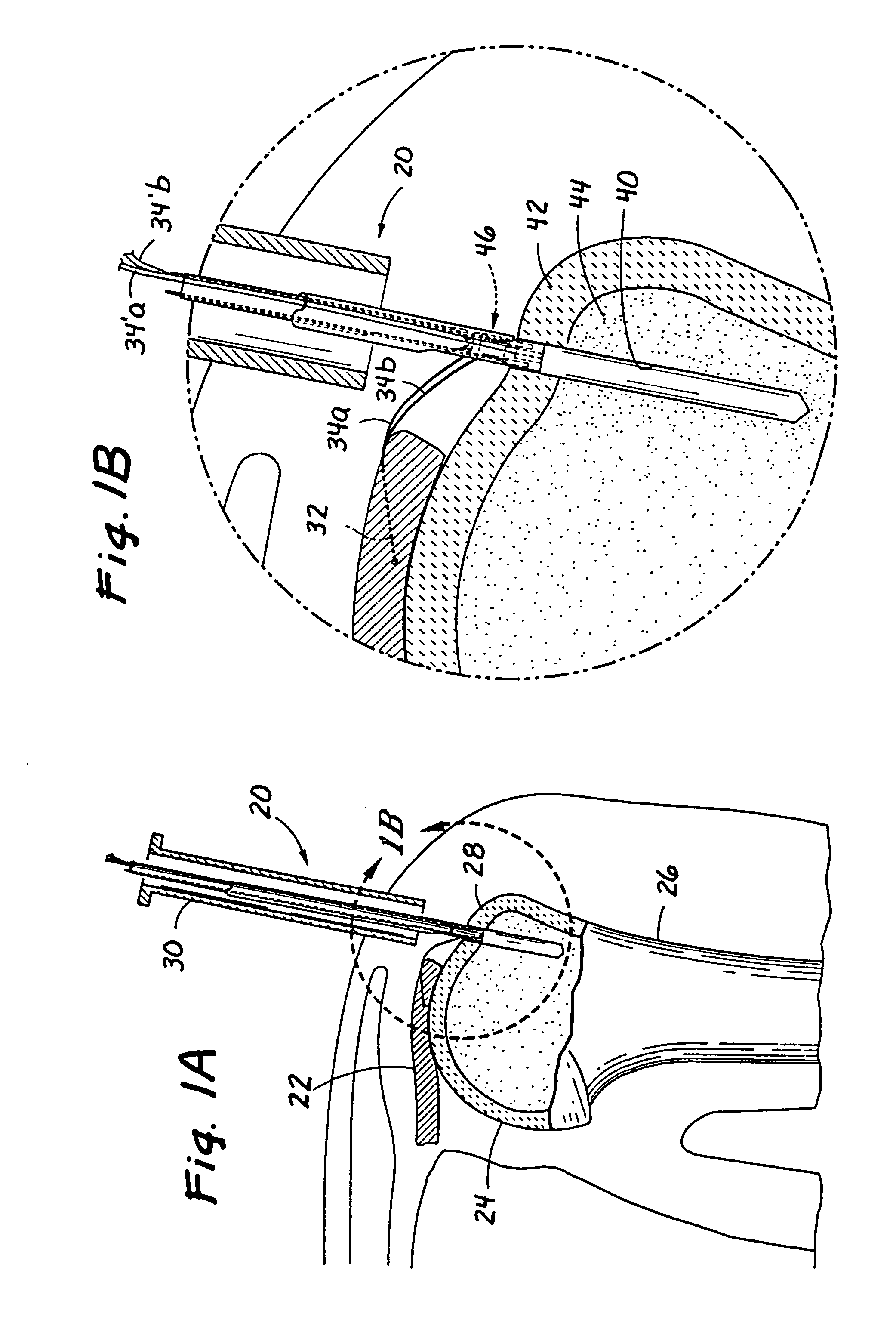 Devices and methods for repairing soft tissue