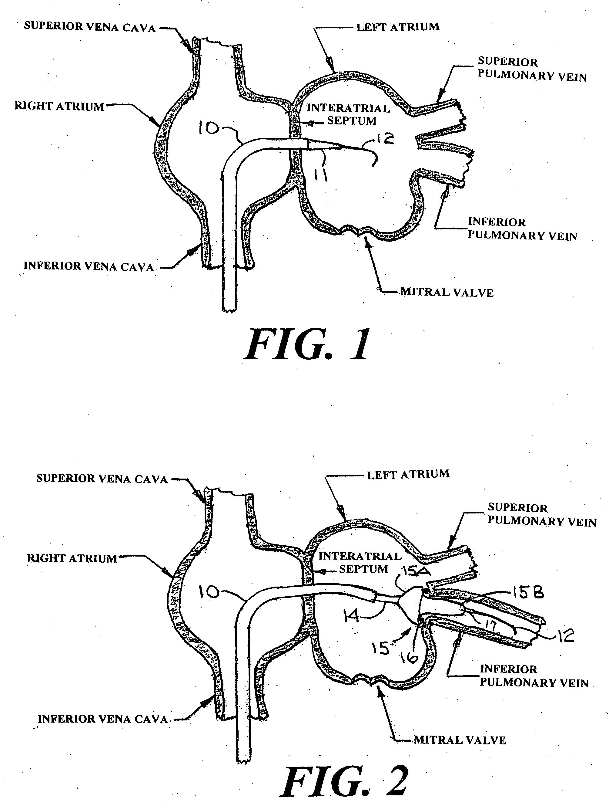 Catheter system for the treatment of atrial fibrillation