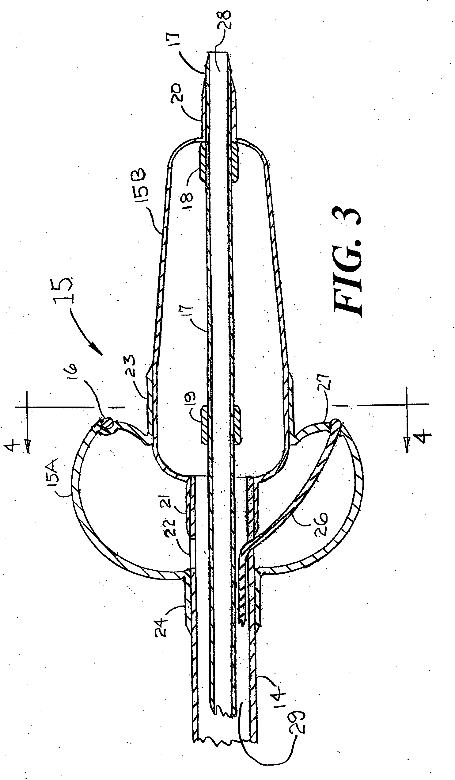 Catheter system for the treatment of atrial fibrillation