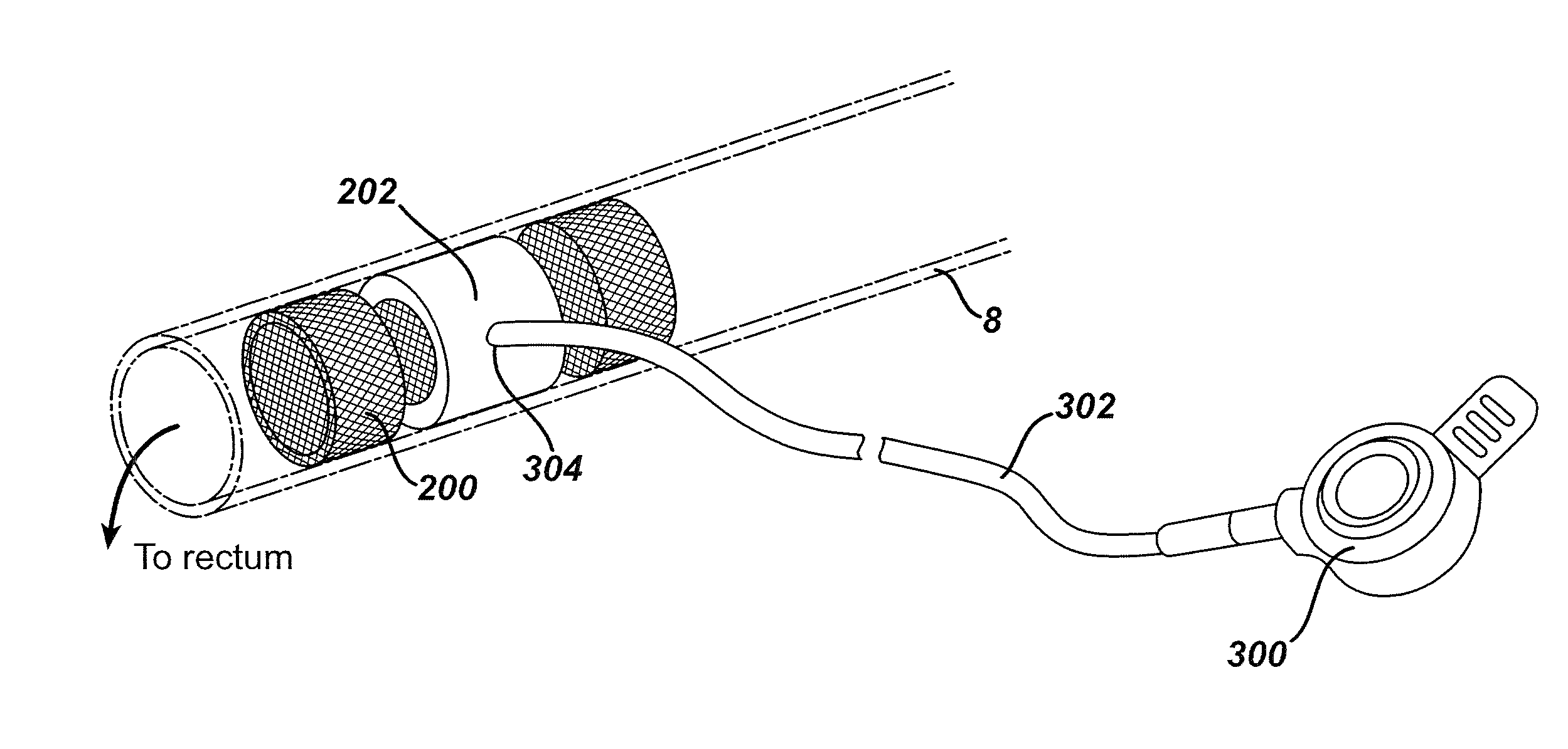 Intestinal brake inducing intraluminal therapeutic substance eluting devices and methods