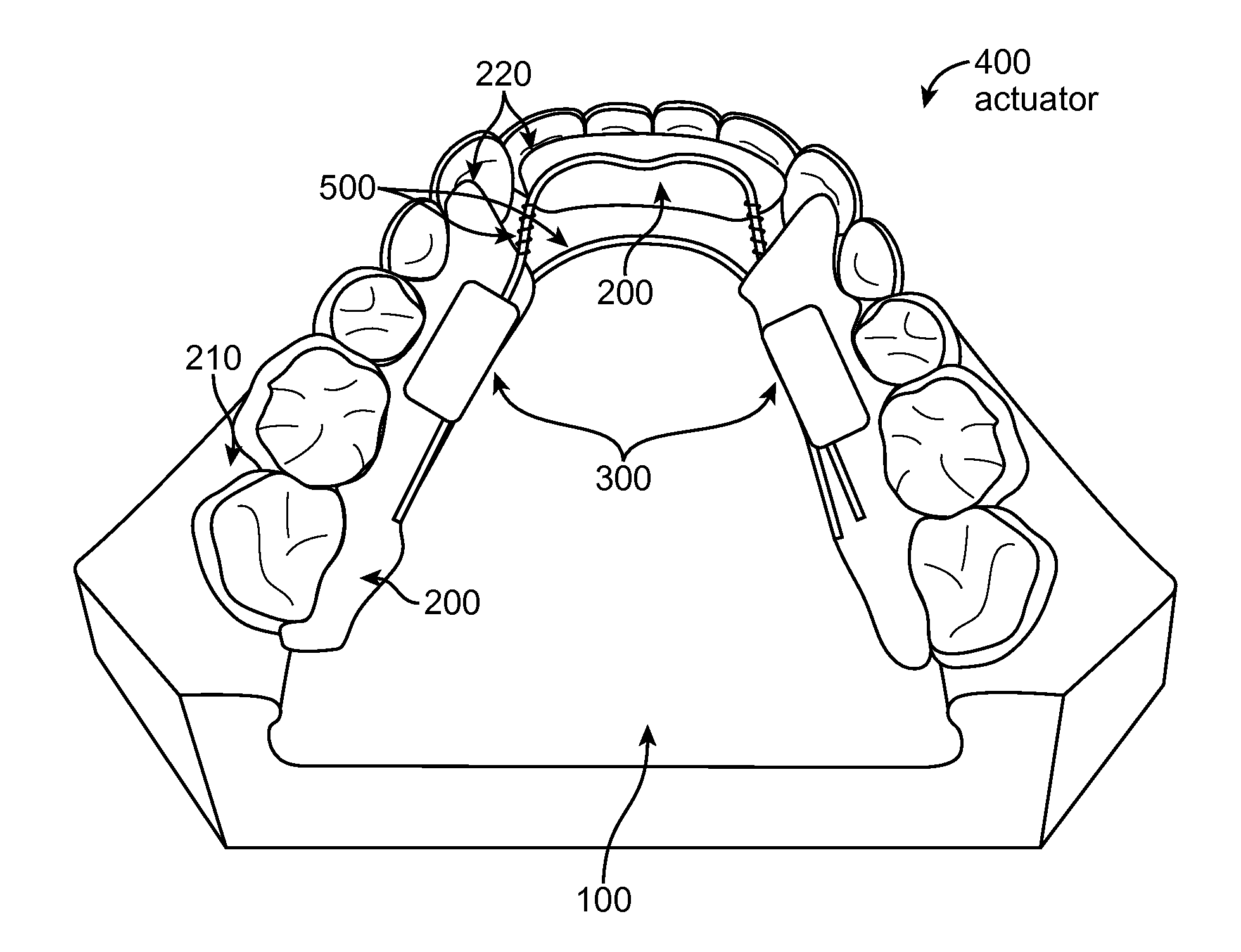 Cyclic interruptive force orthodontic device and system