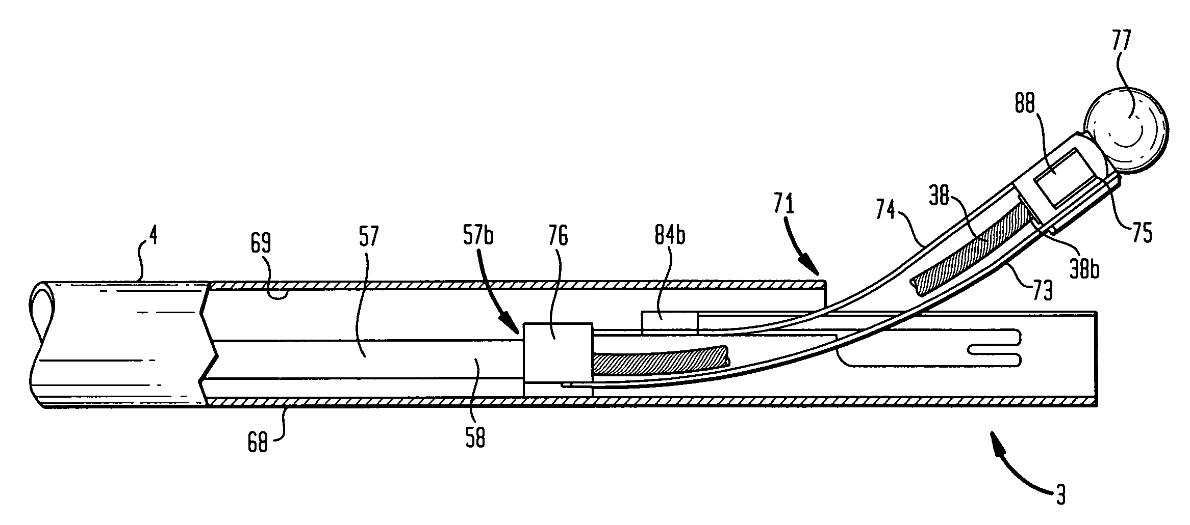 Method and apparatus for removal of tissue