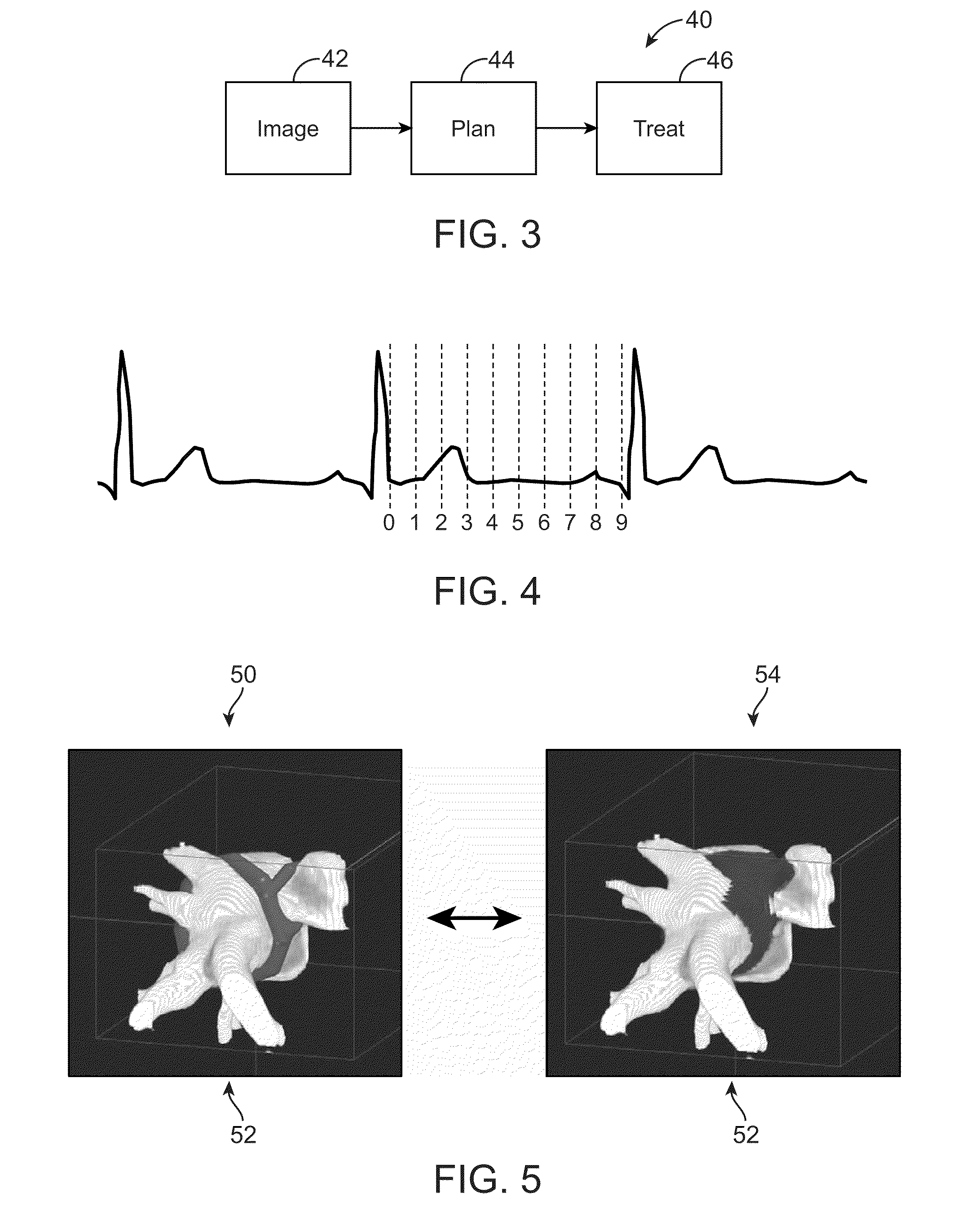 Heart Treatment Kit, System, and Method For Radiosurgically Alleviating Arrhythmia