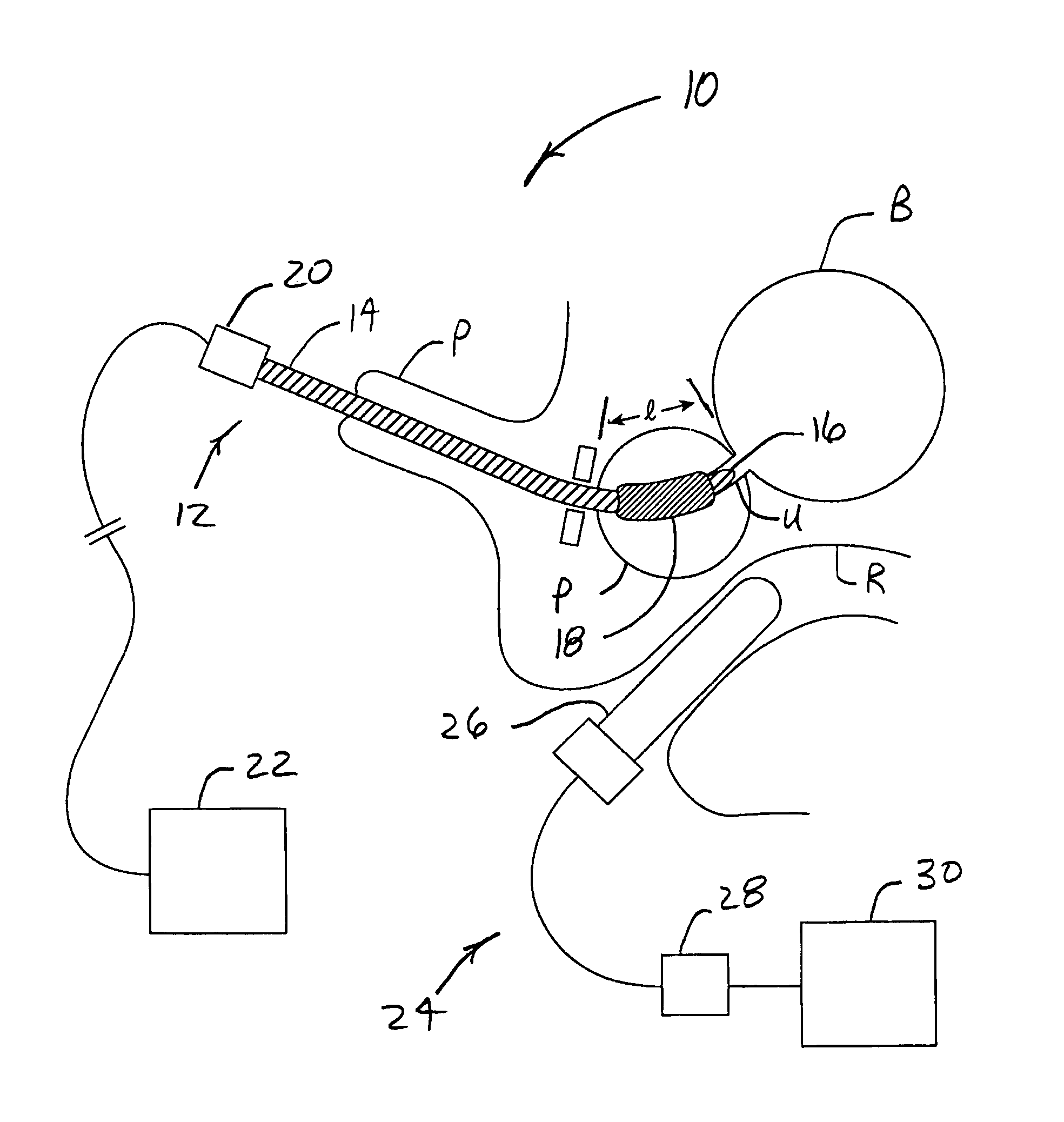 Transurethral systems and methods for ablation treatment of prostate tissue
