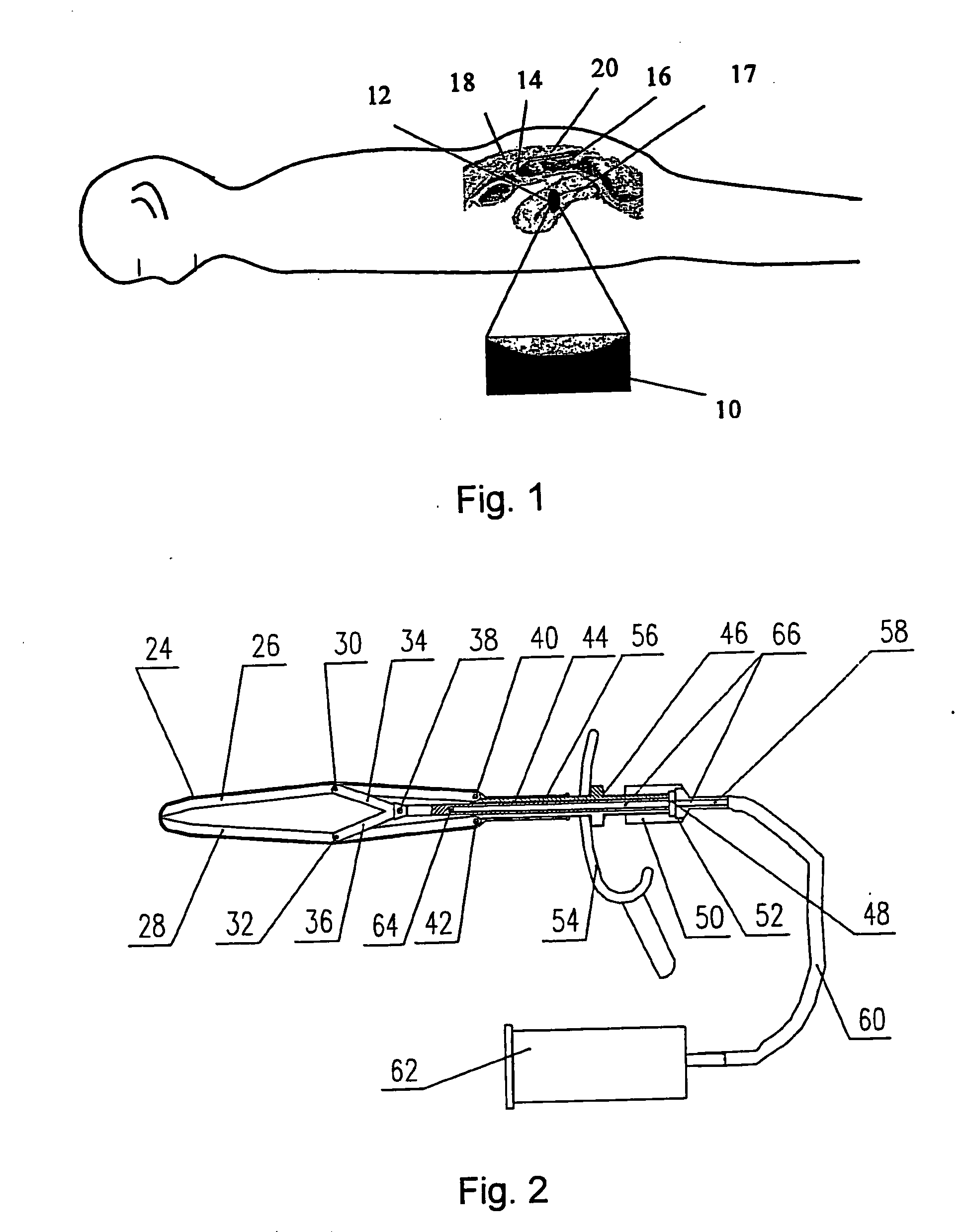 Apparatus for Body Cavity Delivery with Medium, Body Cavity Leading-in and Ultrasound Block