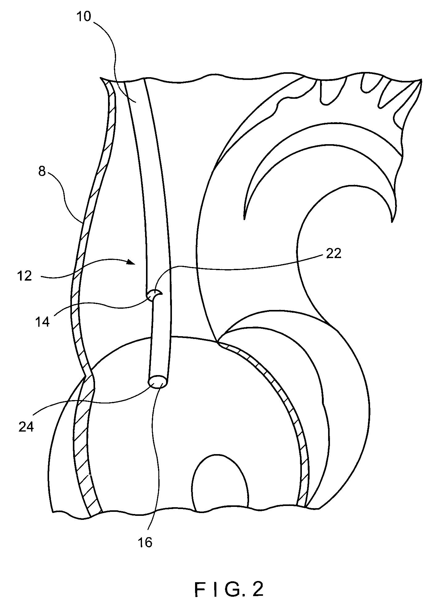 Anti-infective central venous catheter with diffusion barrier layer