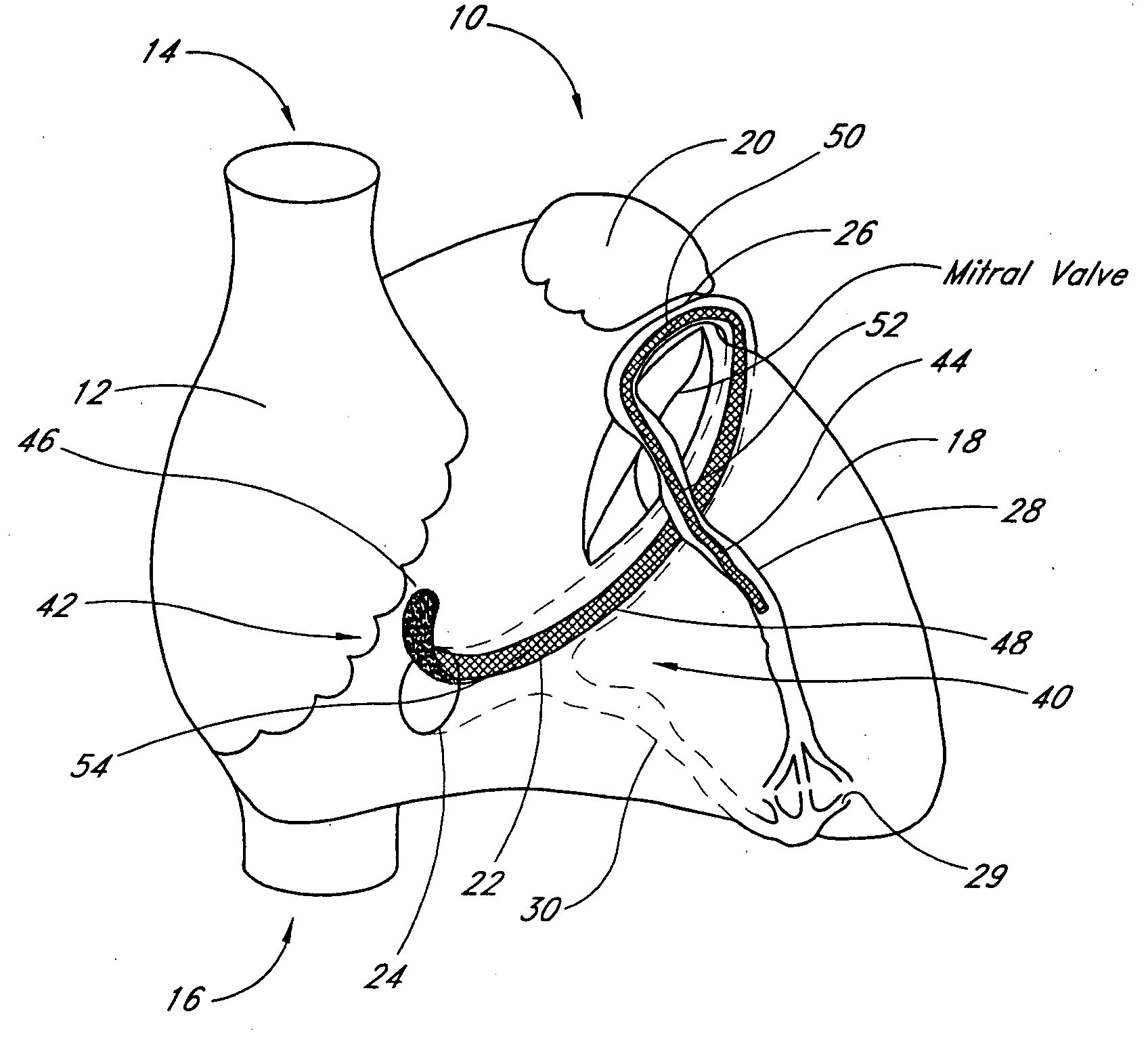 Methods and apparatus for remodeling an extravascular tissue structure