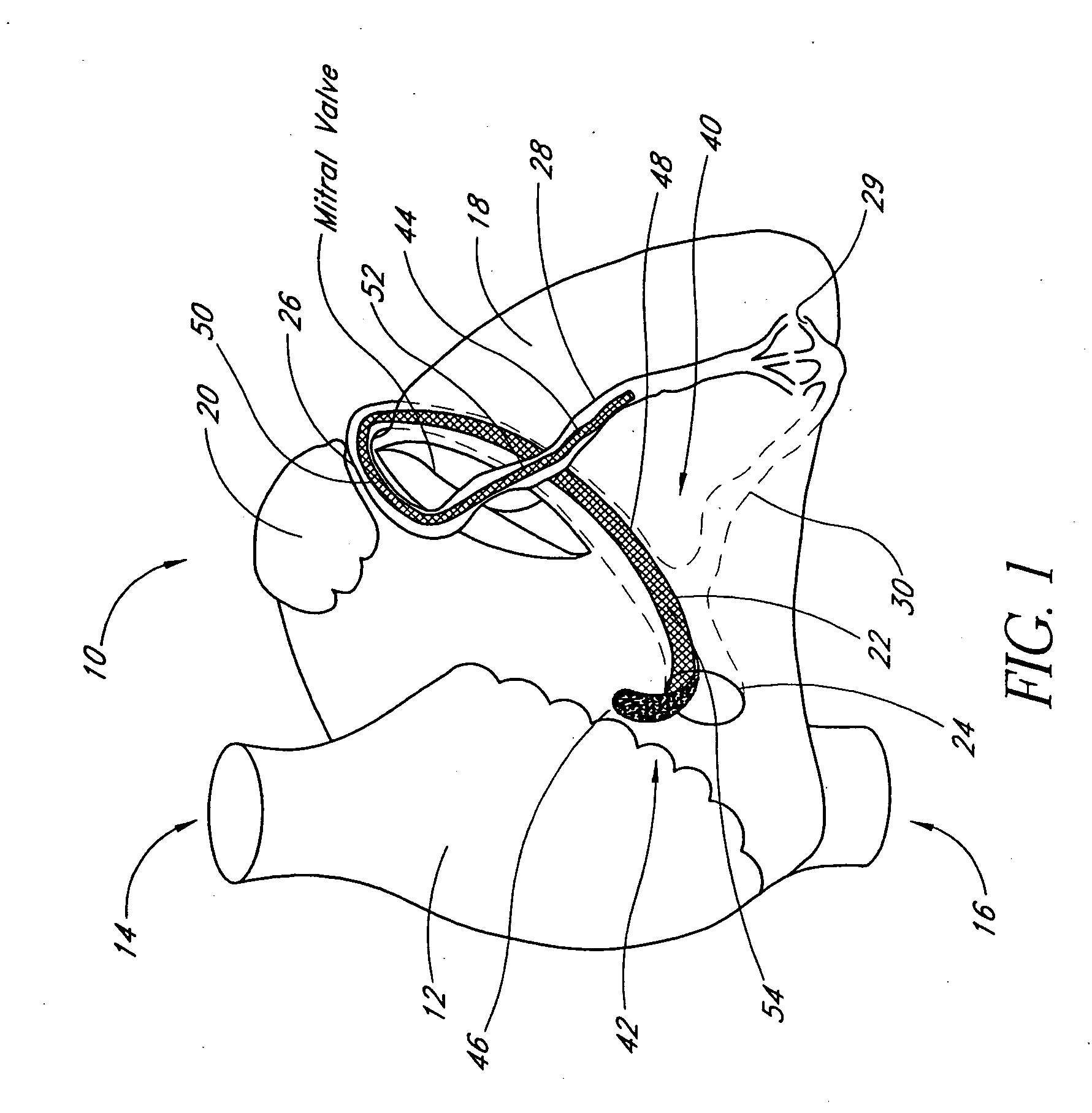 Methods and apparatus for remodeling an extravascular tissue structure