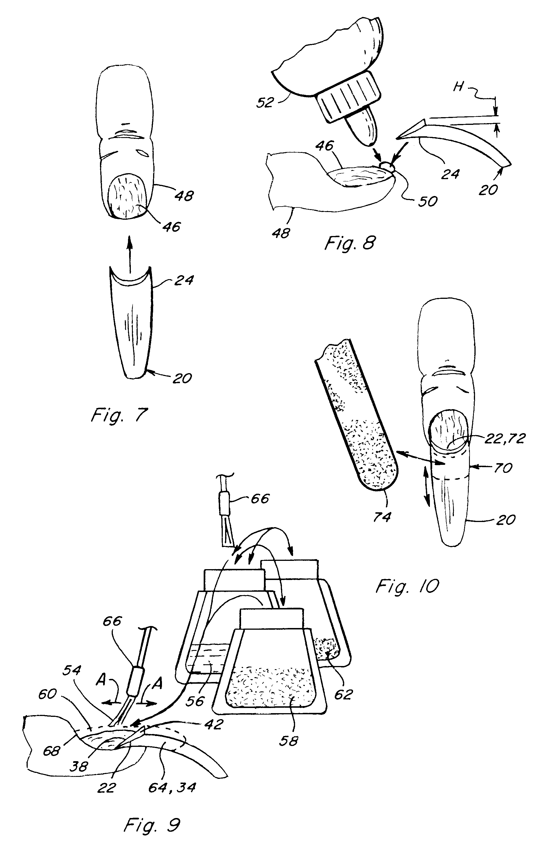 Artificial nail with upstanding feature and method of use